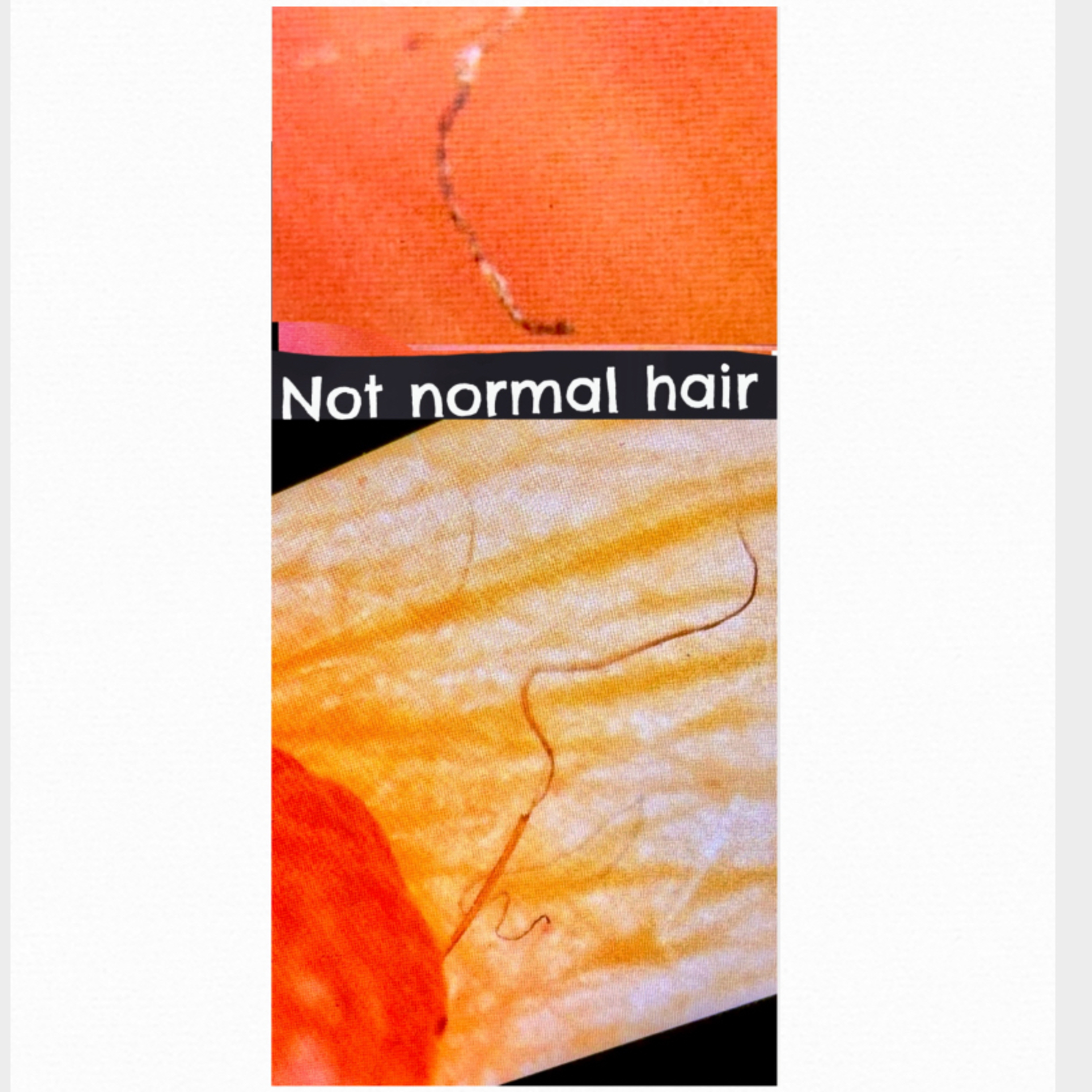 Morgellons Is Not A Mystery