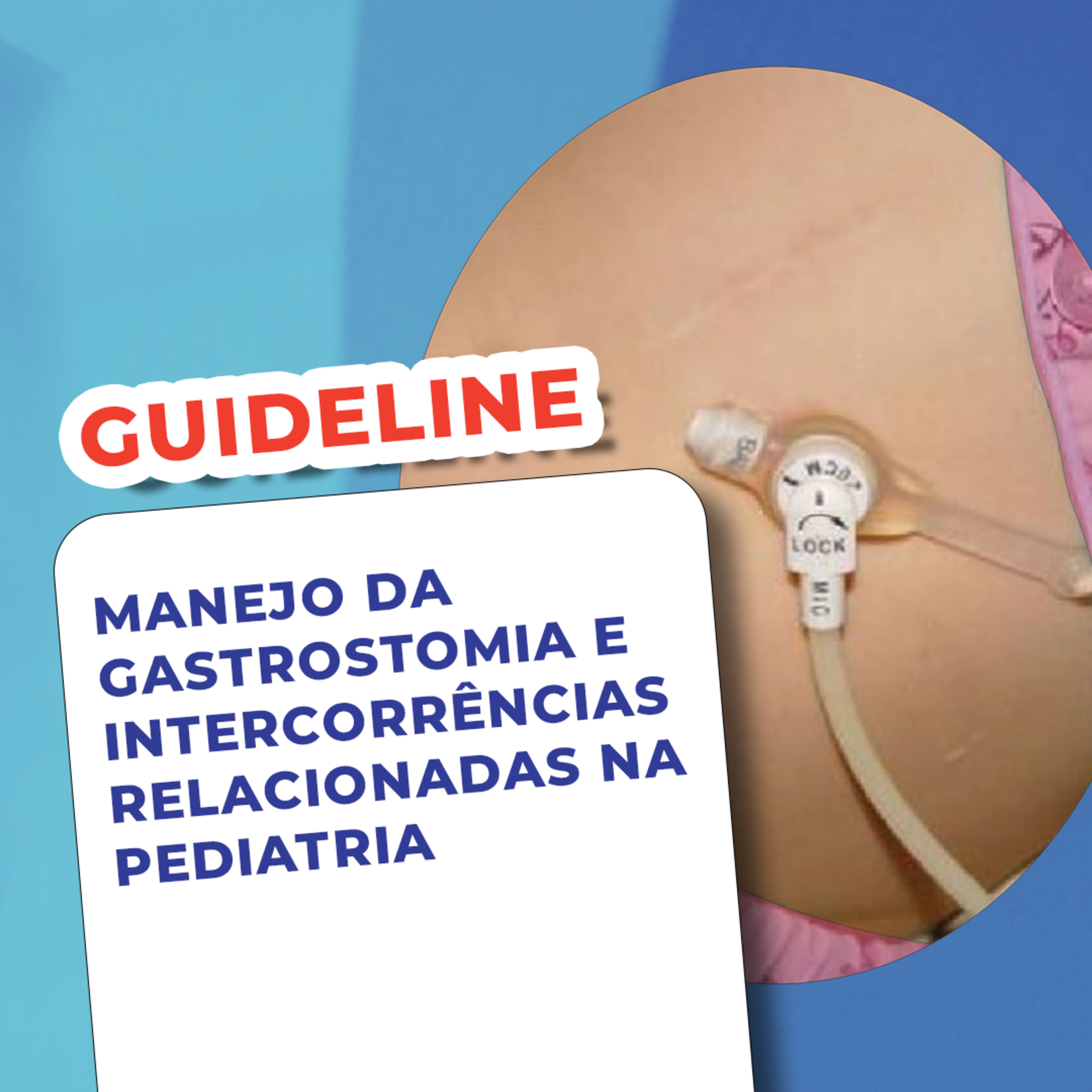 EP 125 - Solucionando problemas em gastrostomia pediátrica - Guideline