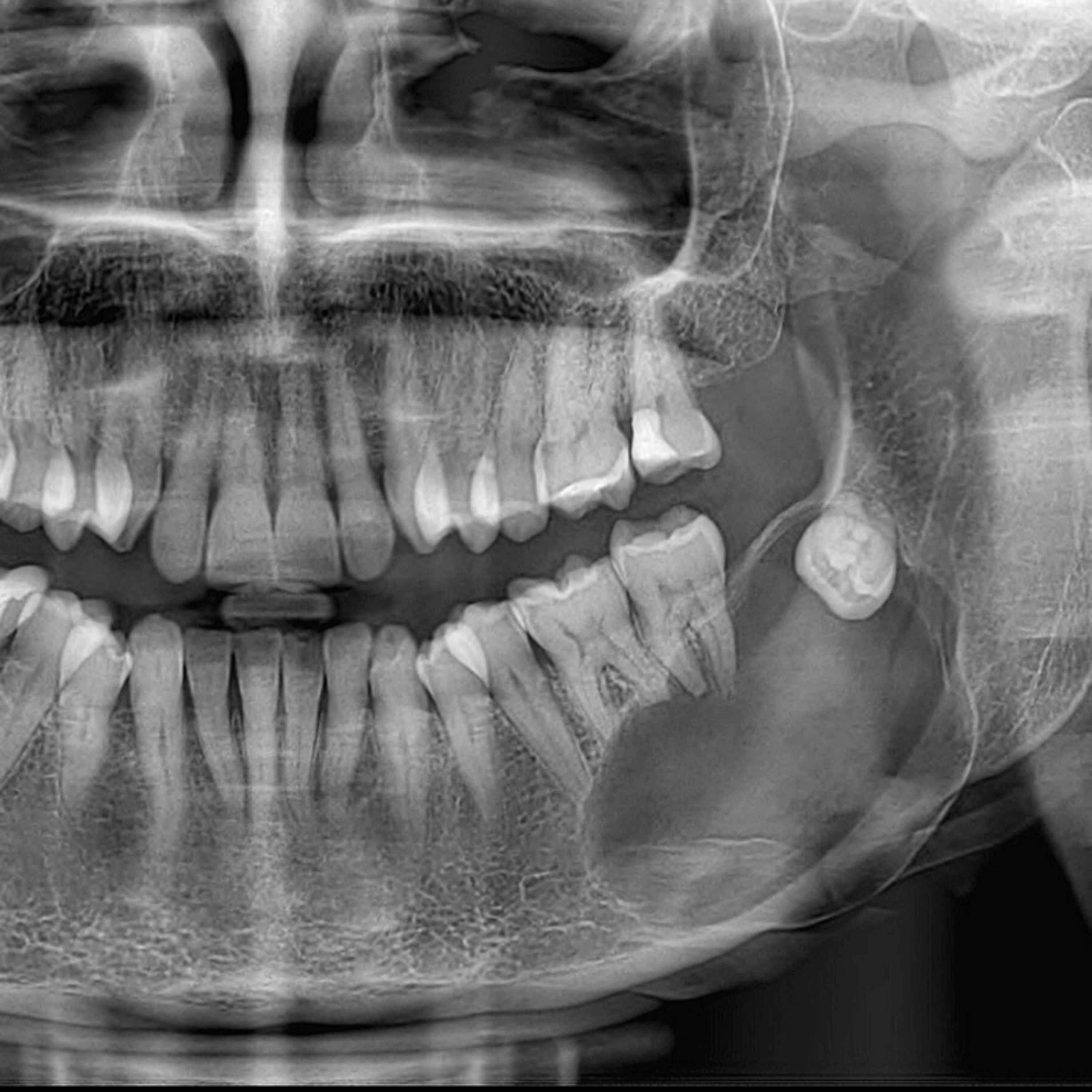 📝 “What are Common Treatment Options for a Dentigerous Cyst?” episode artwork