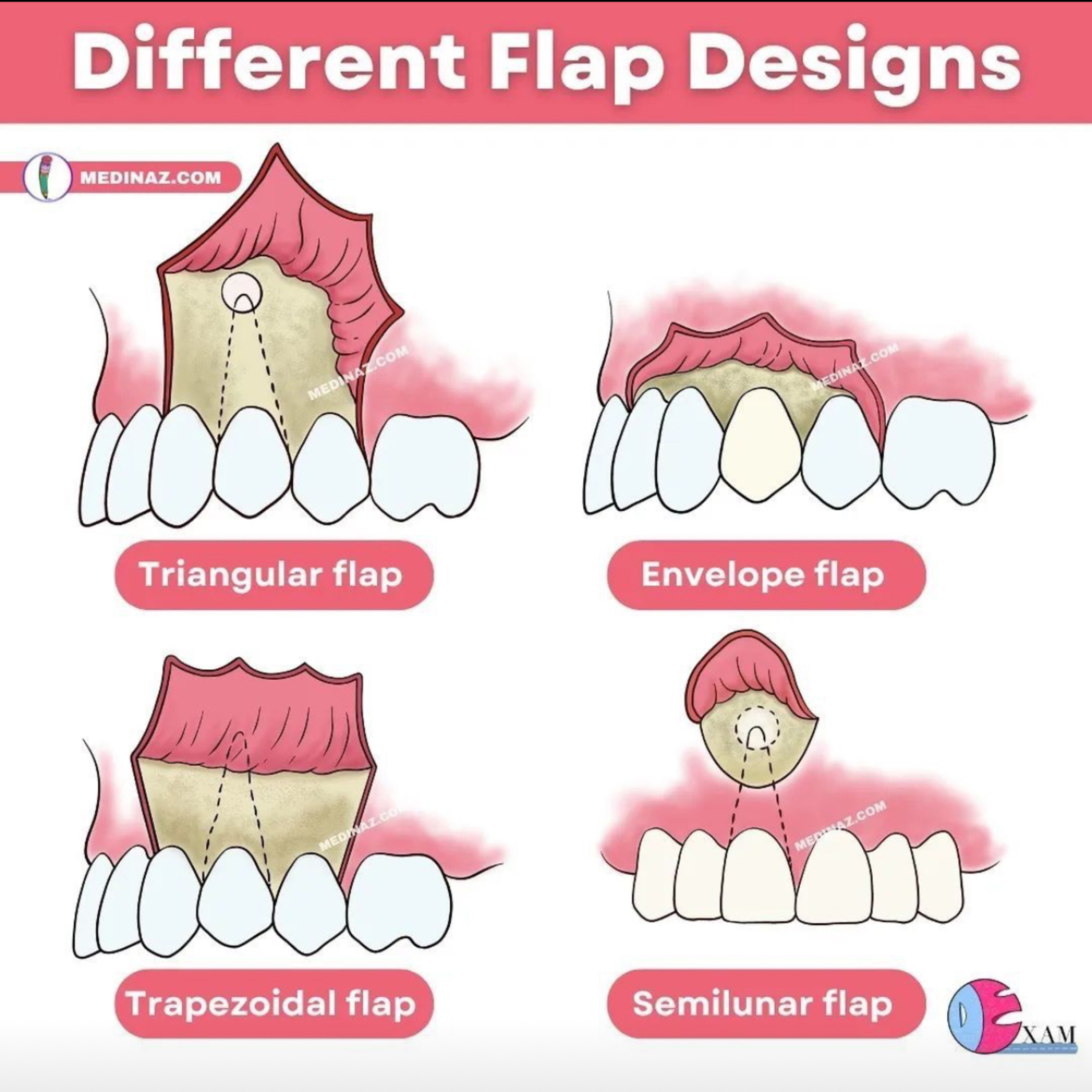 📝 “What are Common Flap Designs Used in Dentistry?” episode artwork