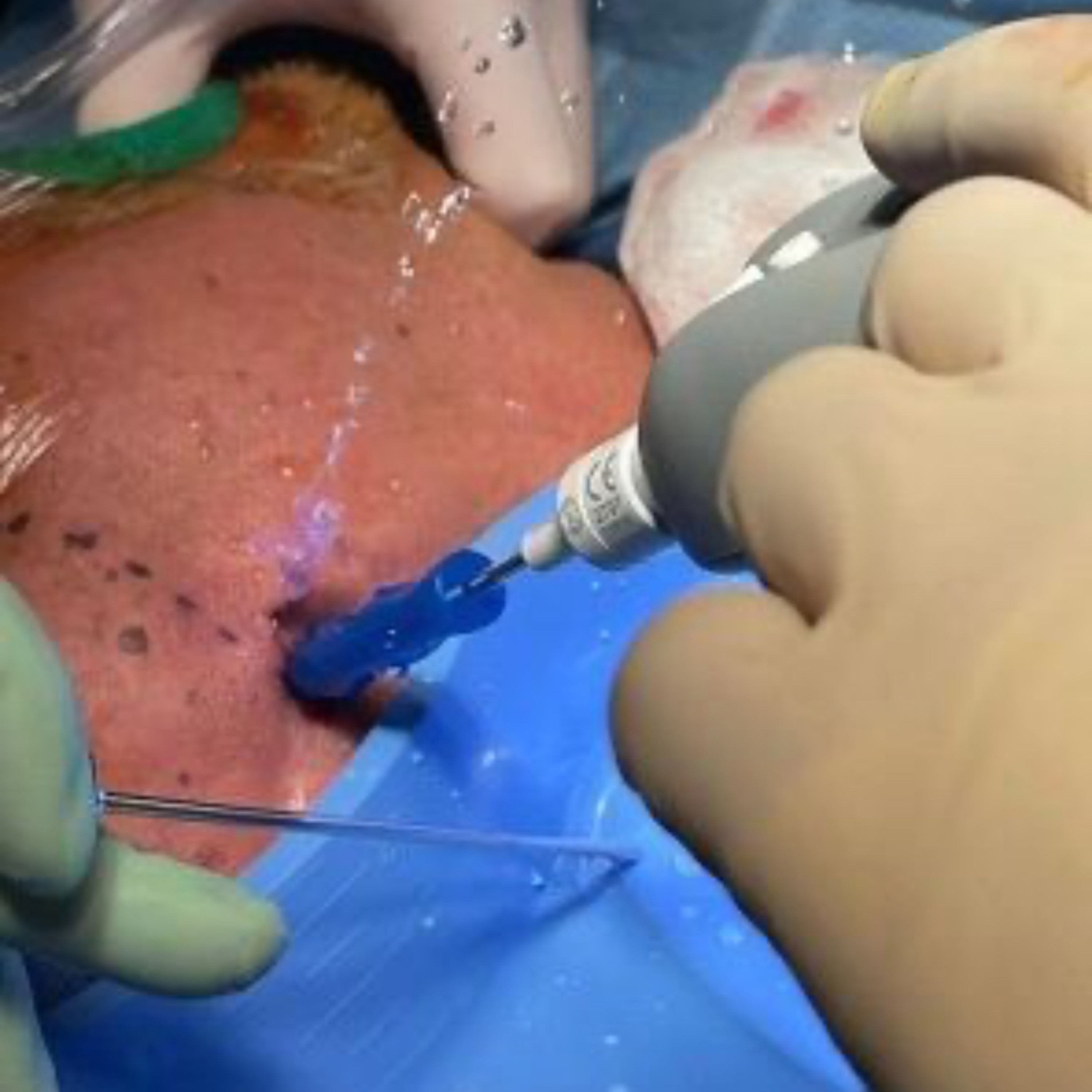 📝 “What is the Difference Between TMJ Arthrocentesis & Arthroscopy?” episode artwork