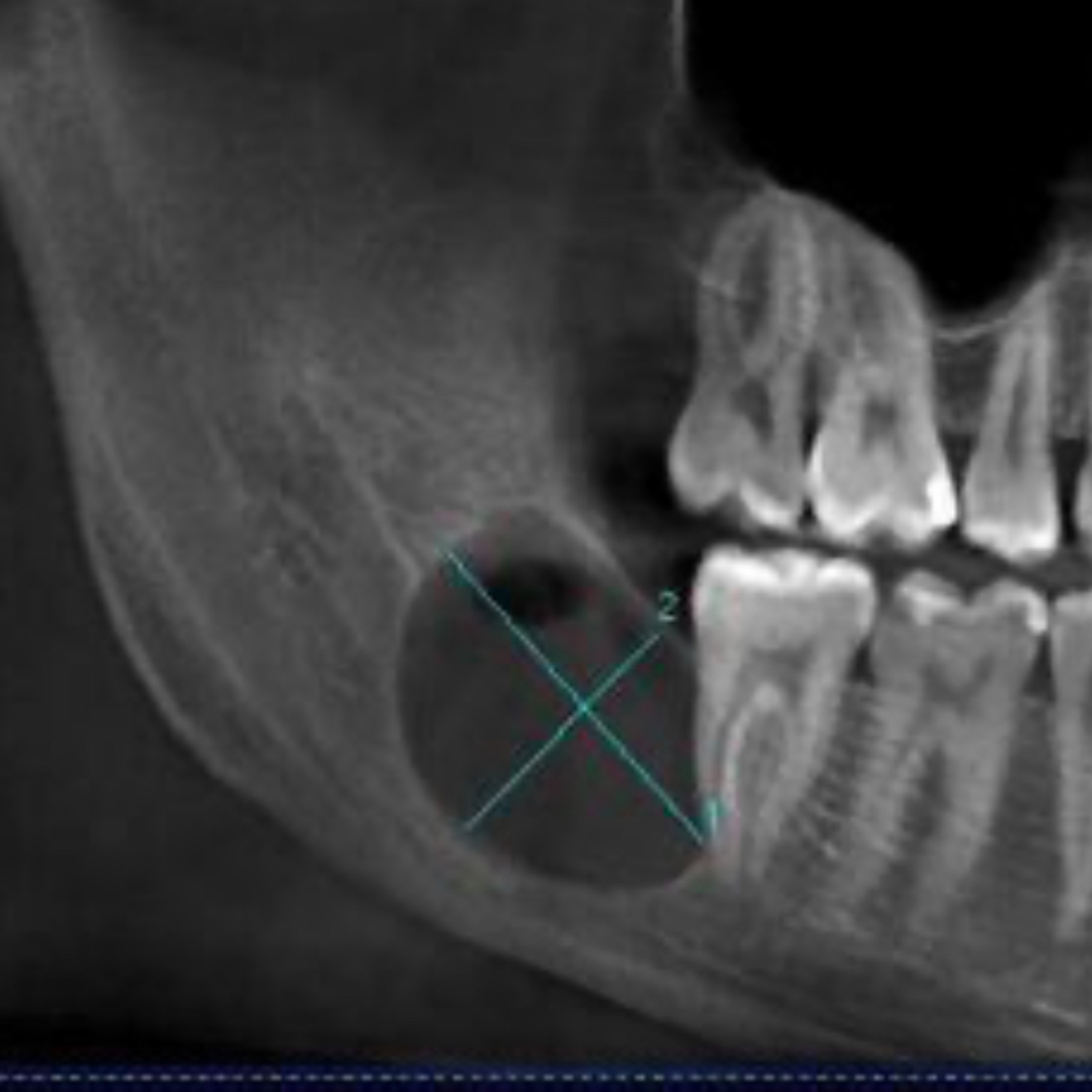 📝 “What are the Top 5 Most Recurrent Cysts of the Oral Cavity?” episode artwork