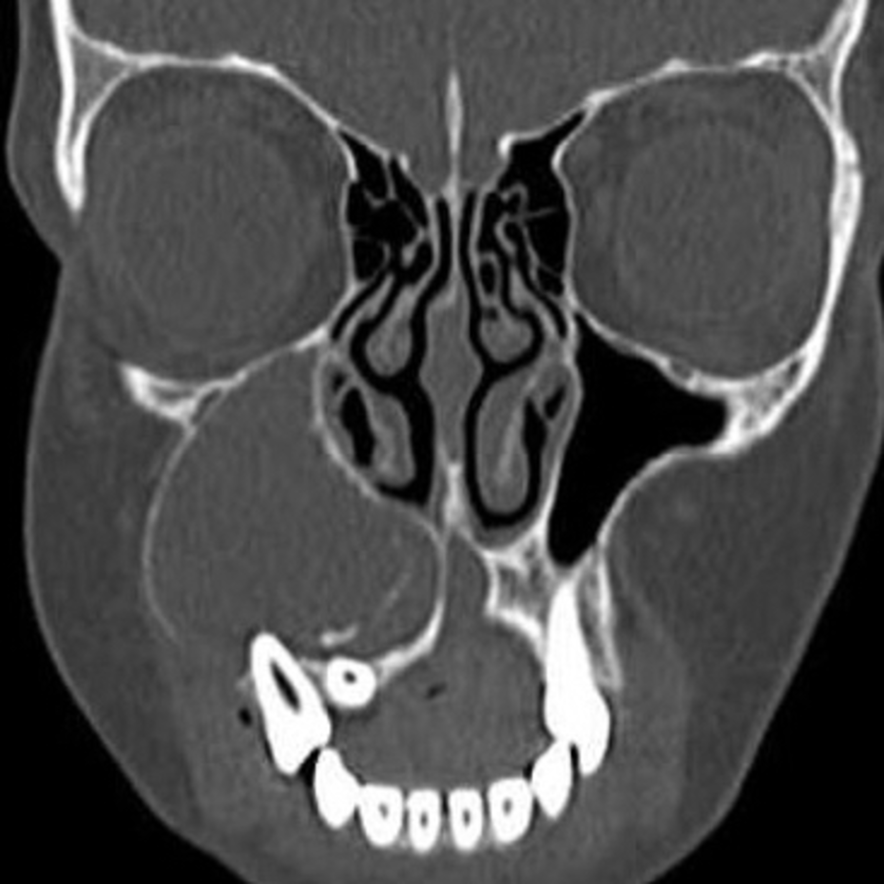 📝 “What are Key Defining Features of the Odontogenic Keratocyst?” episode artwork