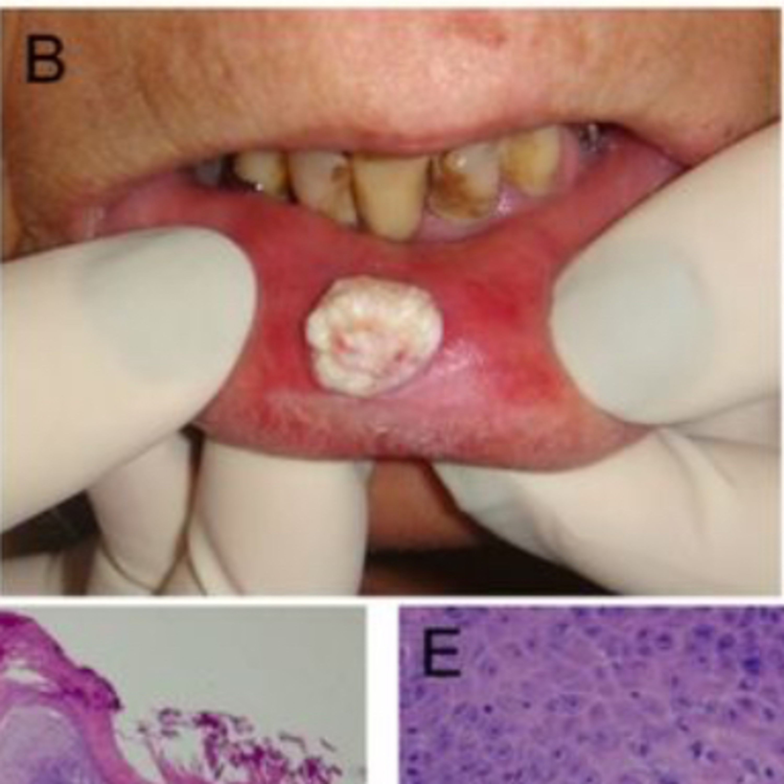 📝 What are the Key Differences Between Proliferative Verrucous Leukoplakia & Verrucous Carcinoma?  episode artwork