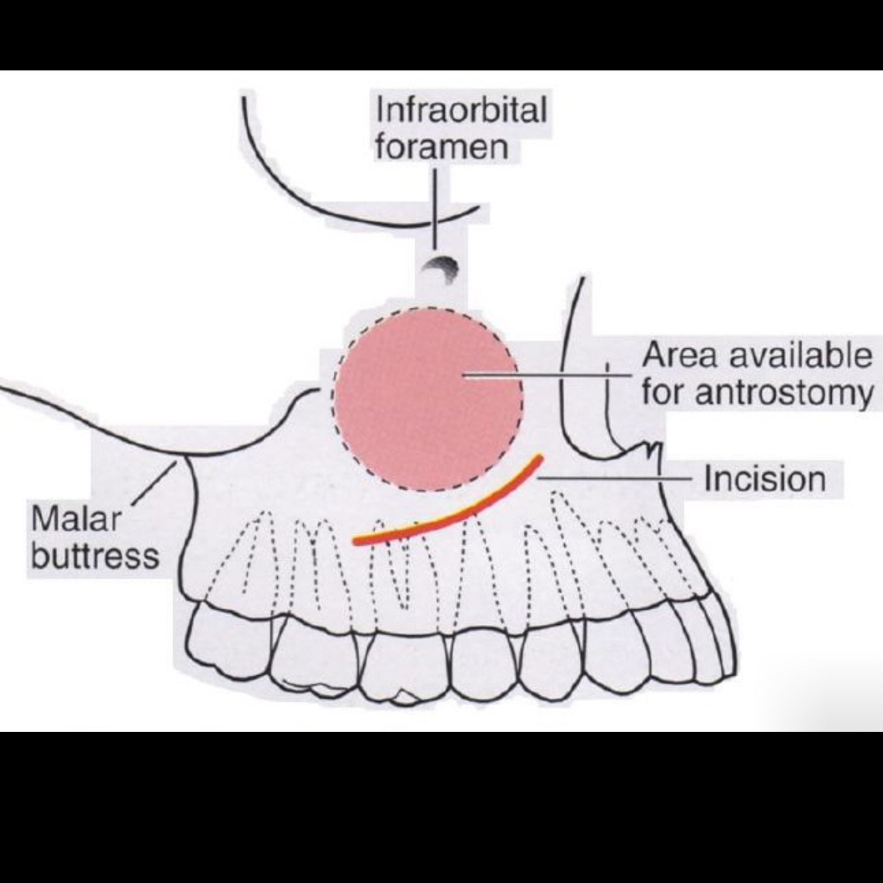 📝 “What is the Caldwell-Luc Procedure for Sinus Lift Surgery?” episode artwork