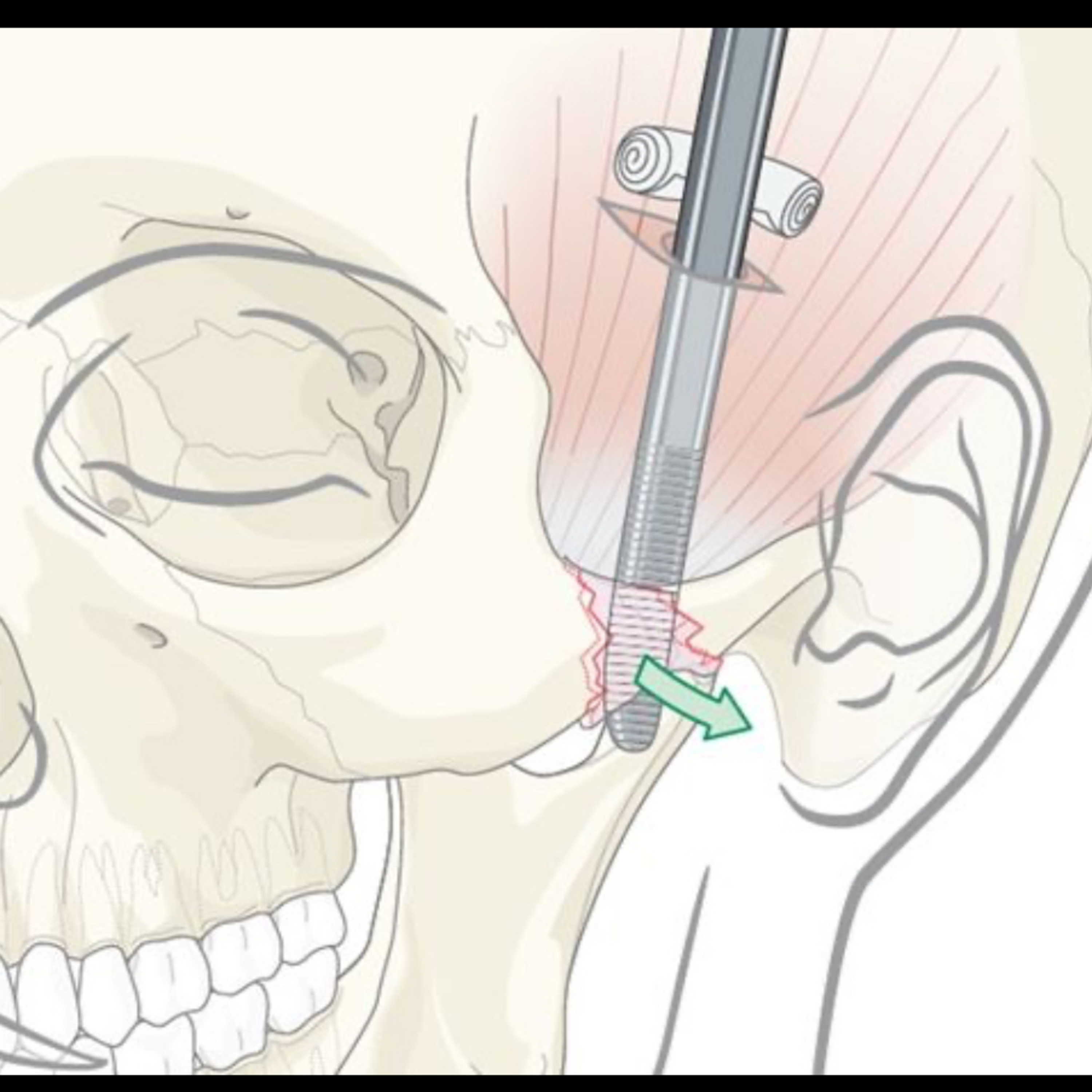📝 “What is the Gillies Approach for Open Reduction of a Zygomatic Arch Fracture?” episode artwork
