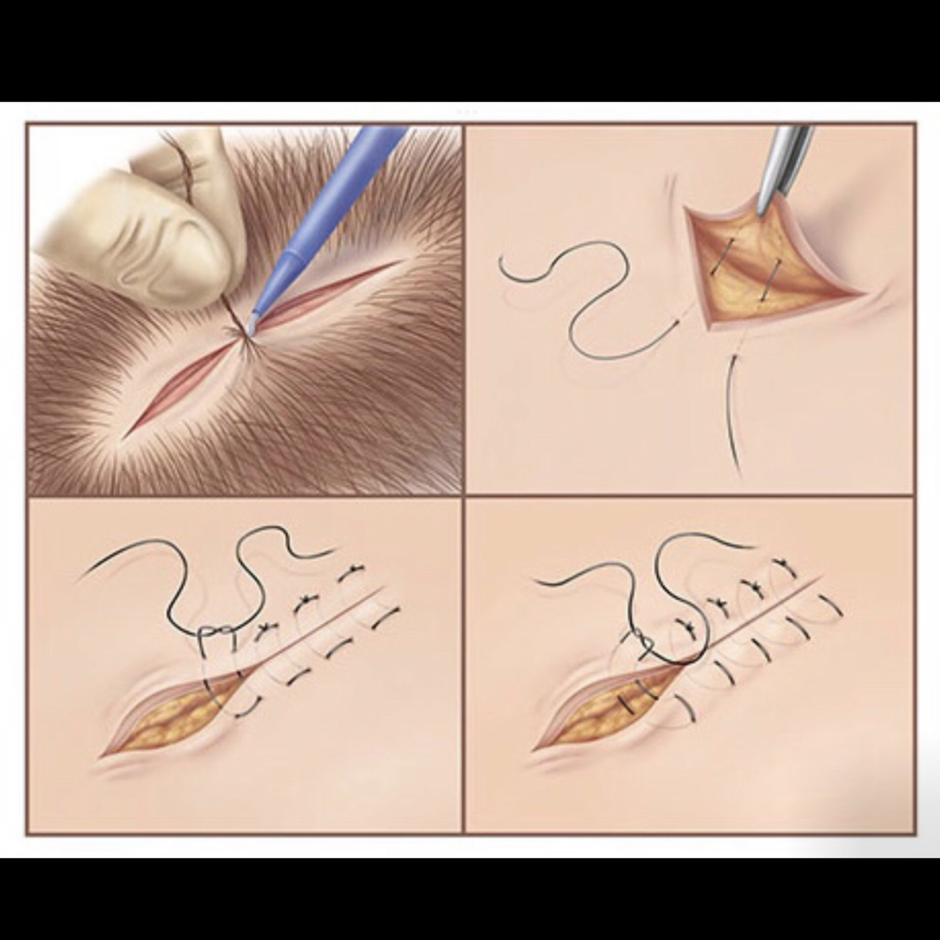 📝 “What Timeframe to Repair an Open Facial Laceration, Without Increasing Risk of Infection/Defect?” episode artwork