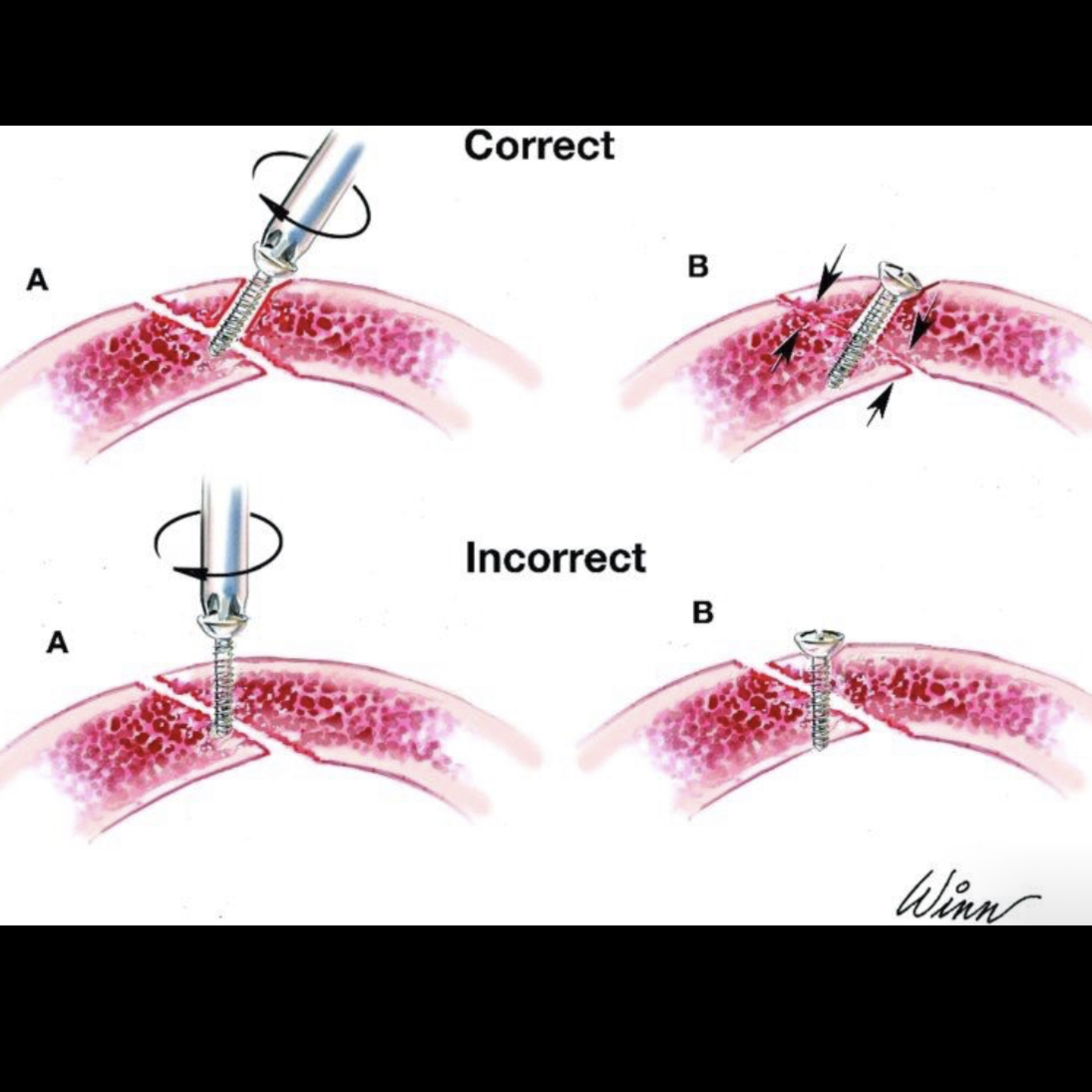 📝 “What is the Lag Screw Technique for Mandible Fractures?”