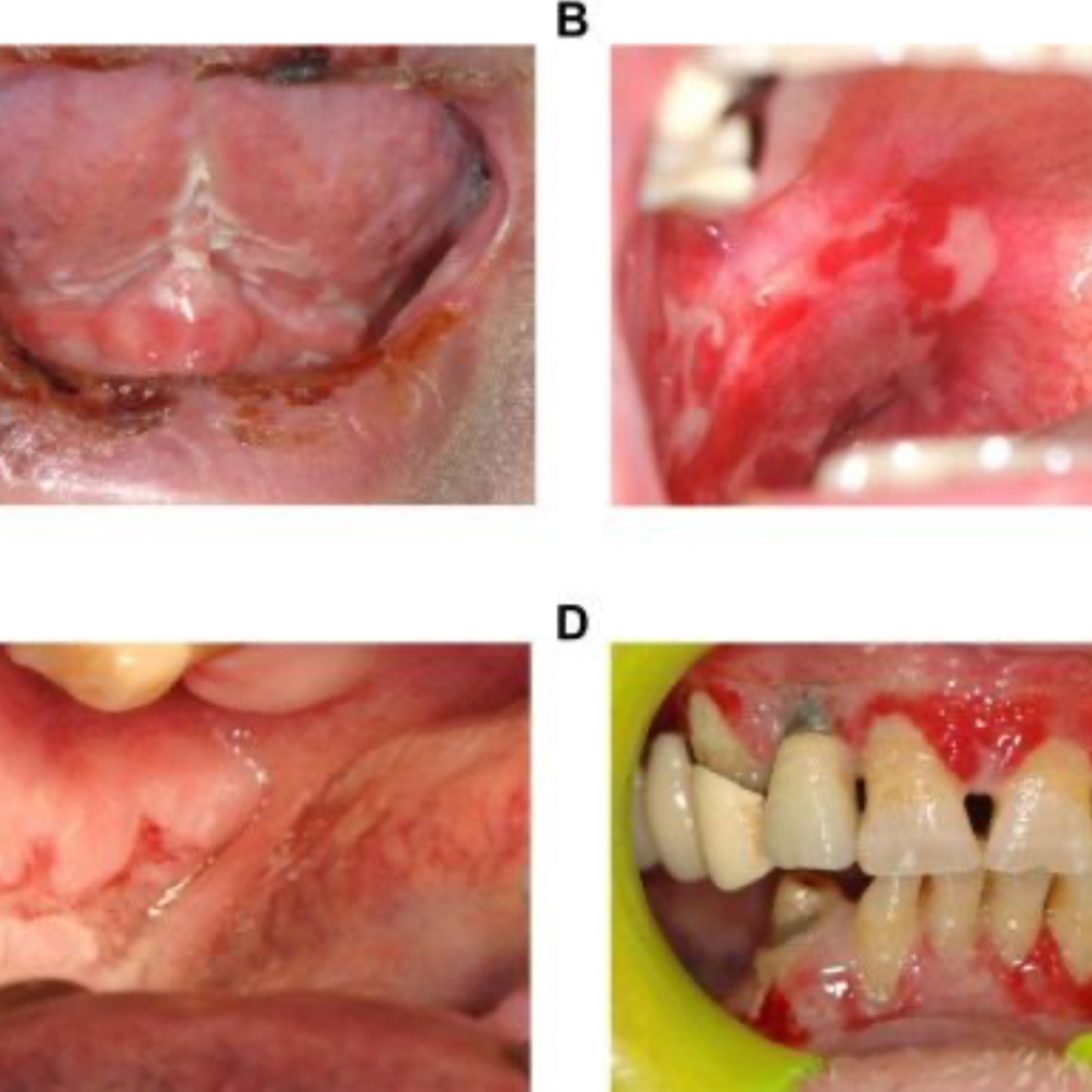 📝 “What are the Key Differences Between MMP, Pemphigus Vulgaris, EM, and Lichen Planus?”