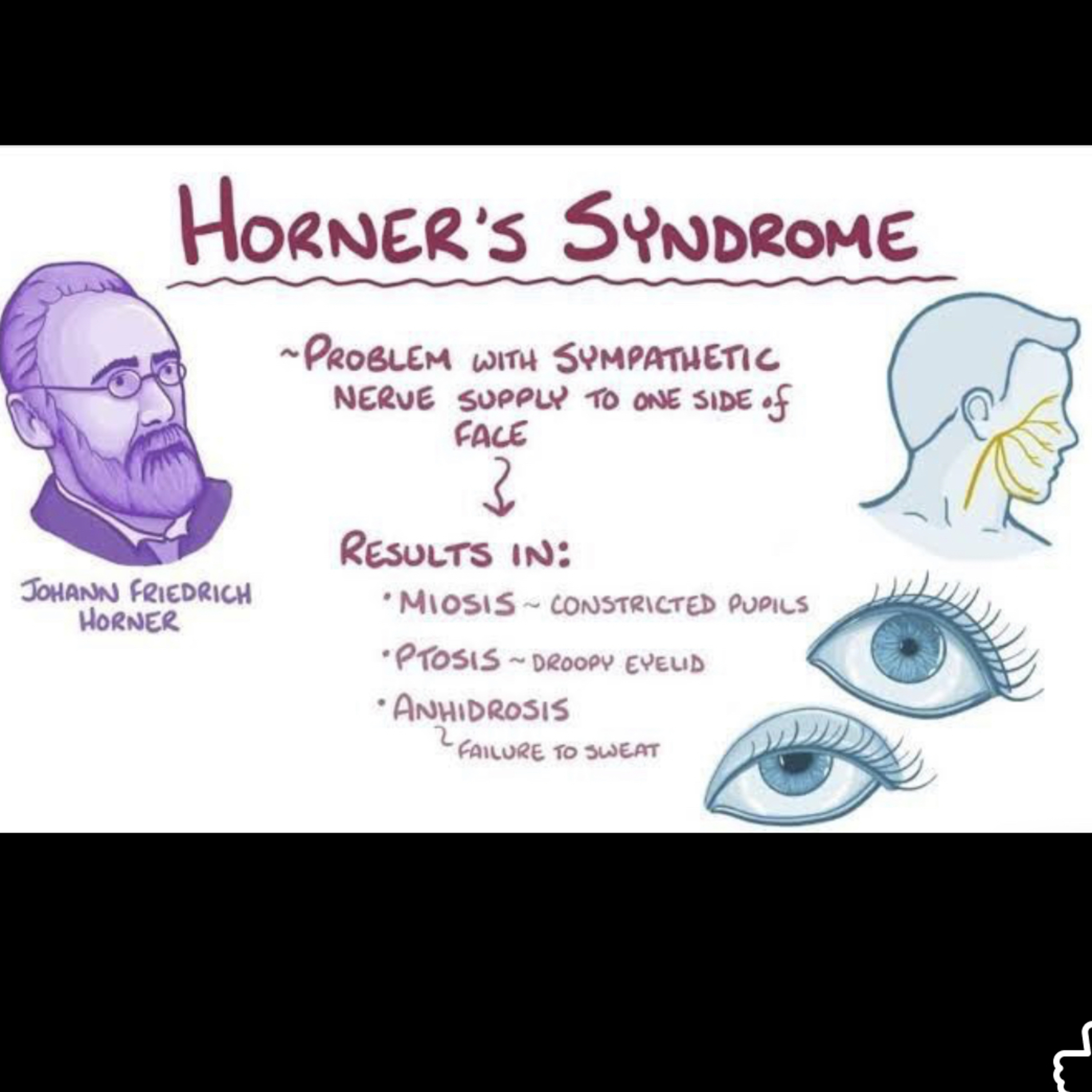 📝 “What are the Differences Between Horner’s & Frey Syndrome?”