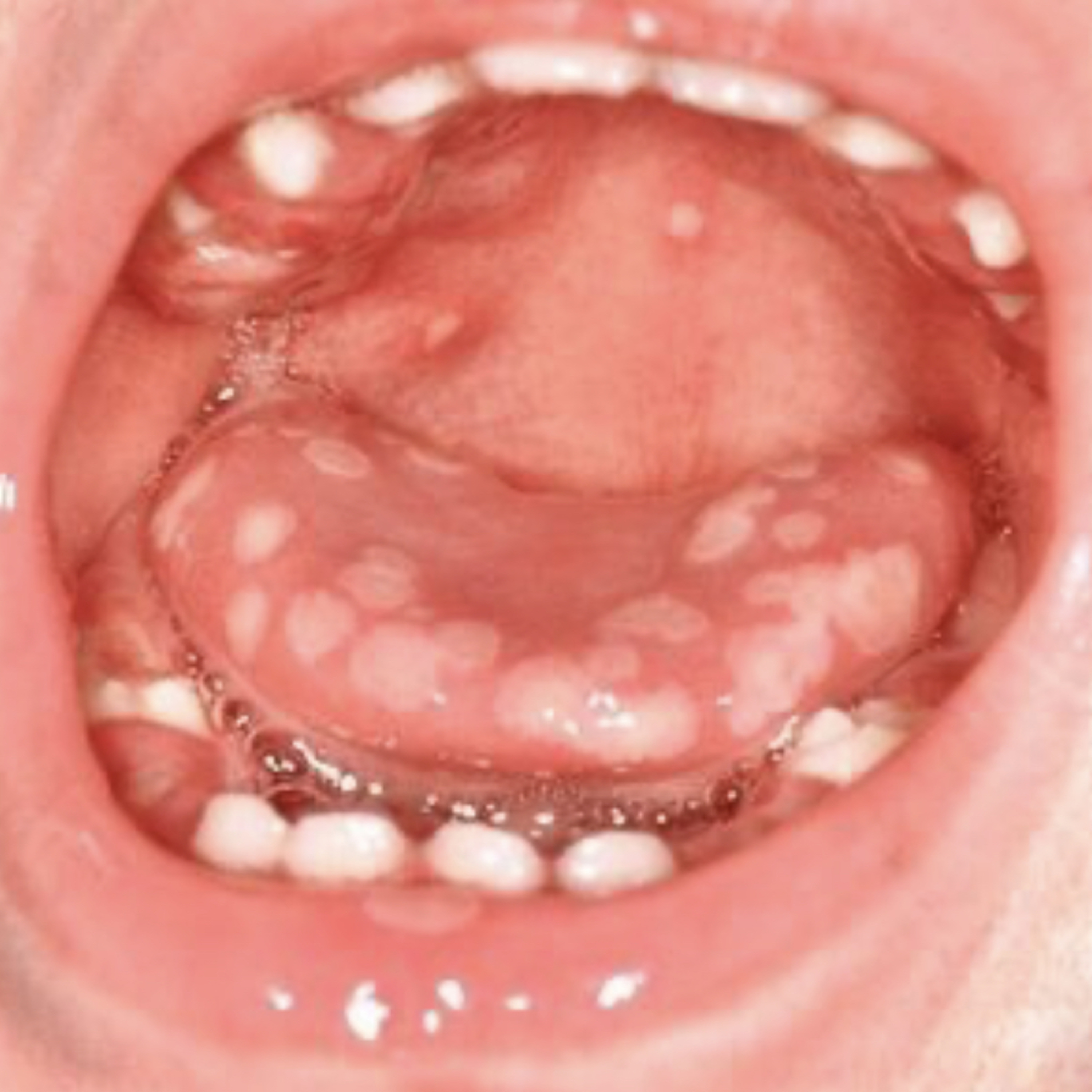 📝 “What Are Key Differences Between Coxsackievirus & Herpetic Stomatitis Oral Manifestations?”