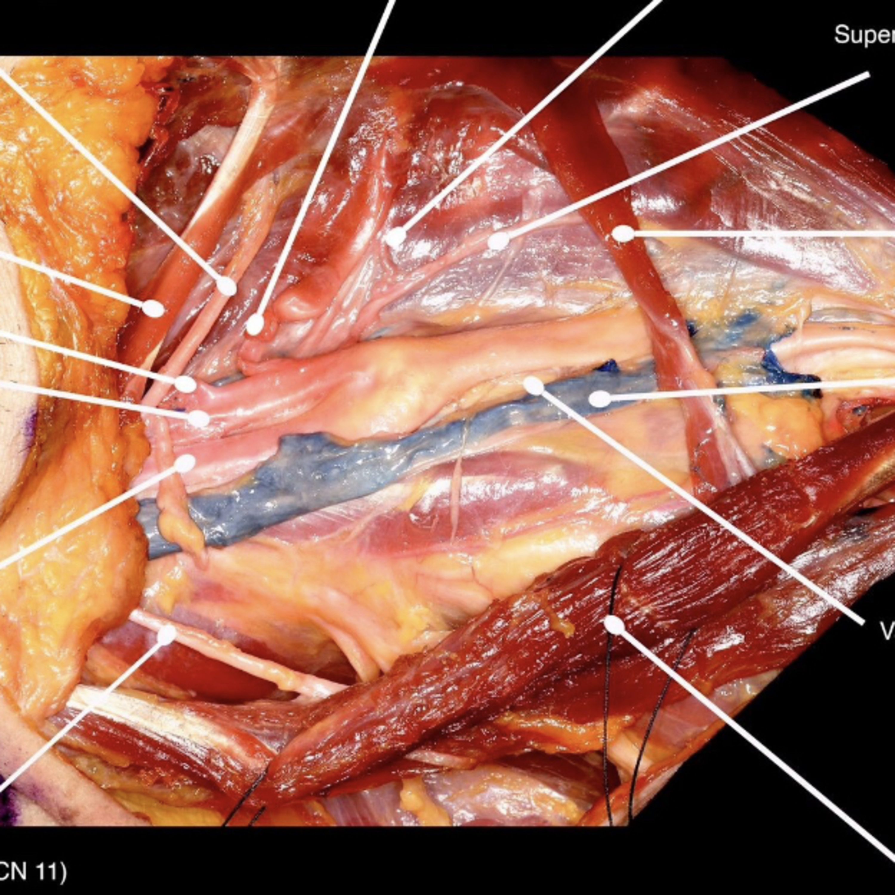 📝 “What are Key Layers & Landmarks of the Neck Dissection?”