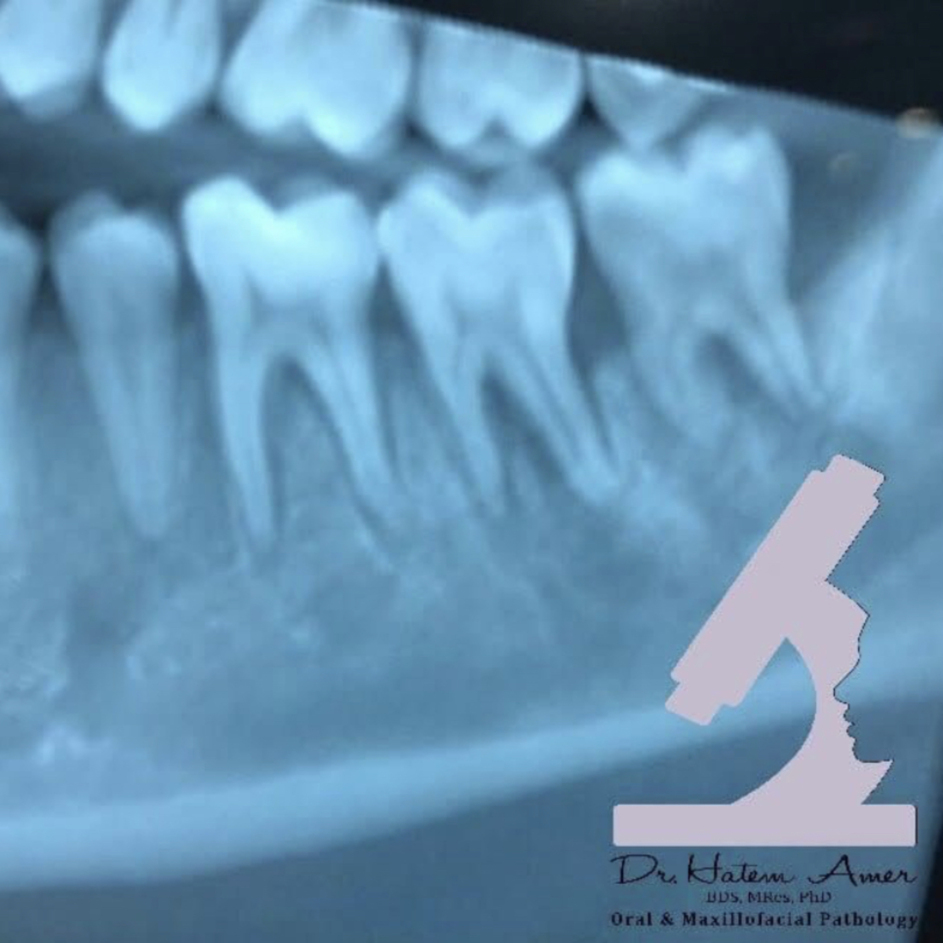 📝 “What is ‘Garrington’s Sign’ on Radiographs?”