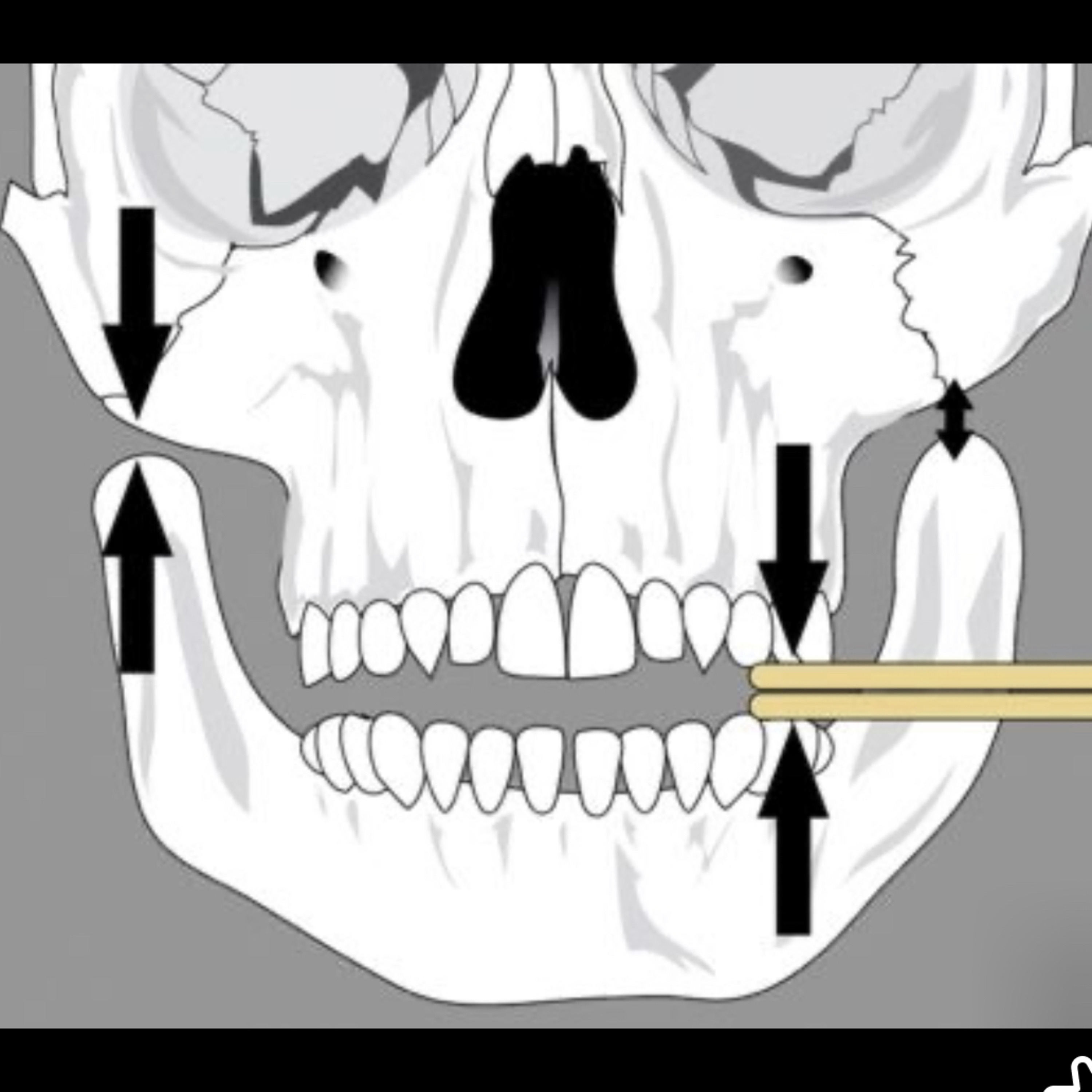📝 “What is TMJ Loading?”