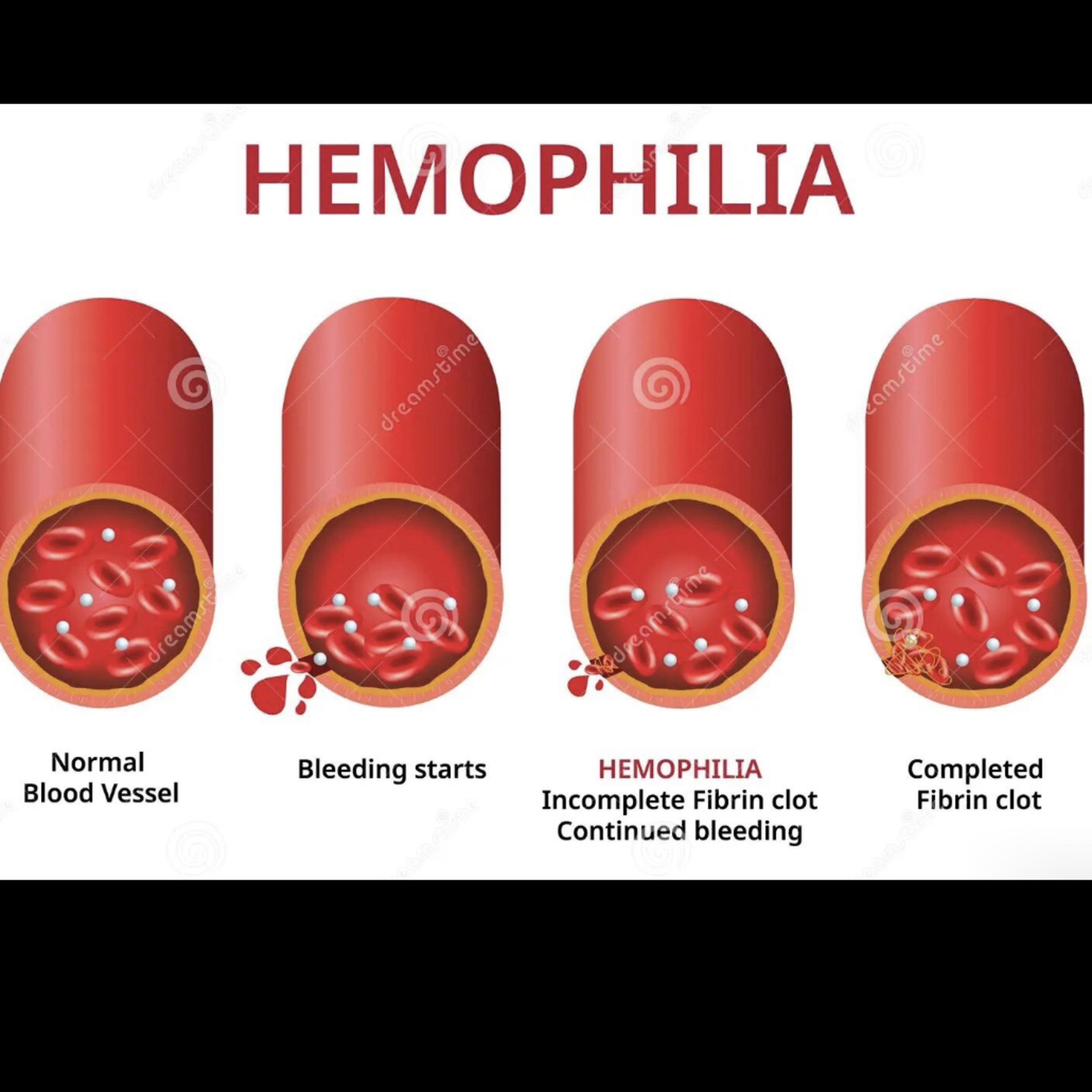 📝 “What are the Different Types of Hemophilia?”