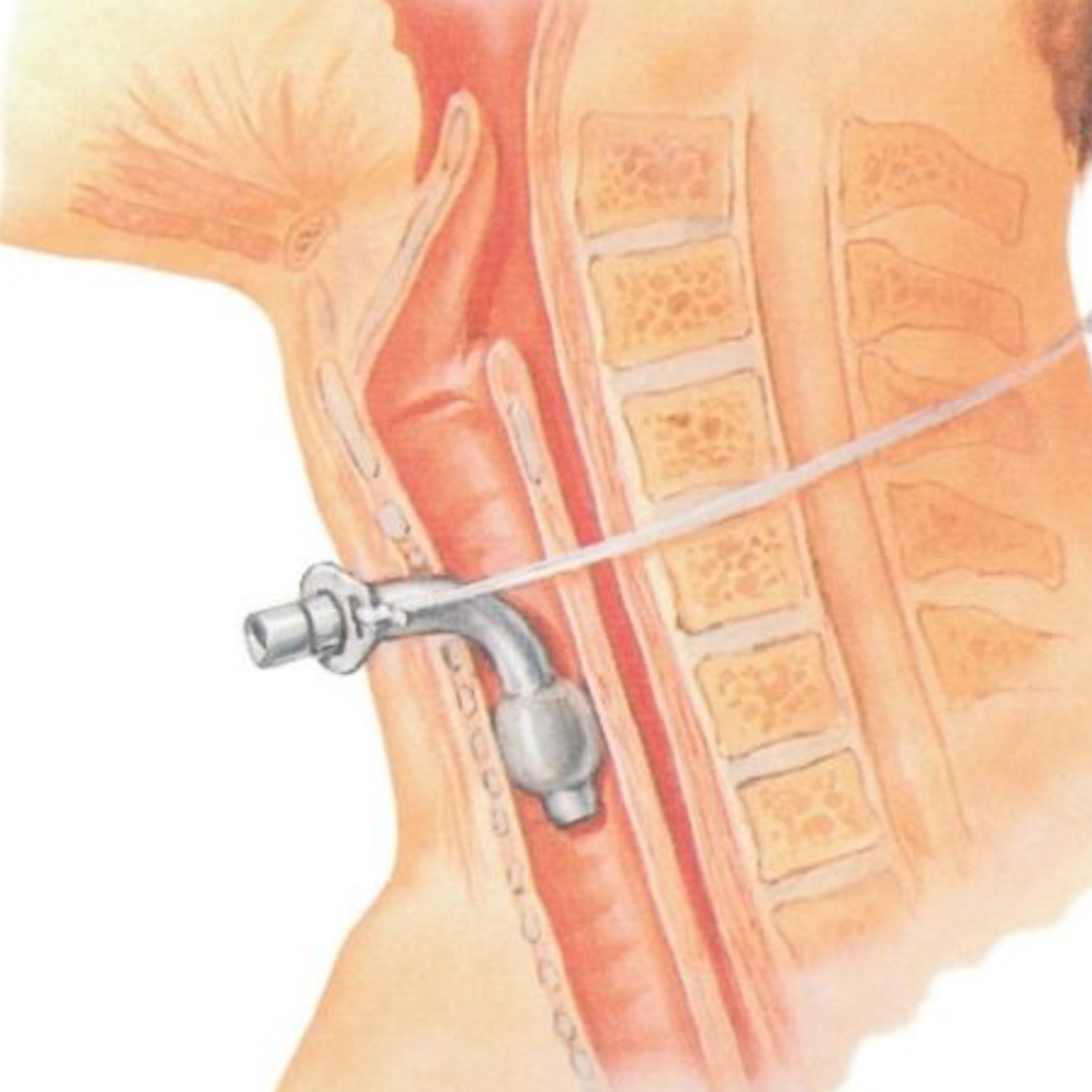 📝 “Is There a Difference Between a Tracheostomy and a Tracheotomy?”