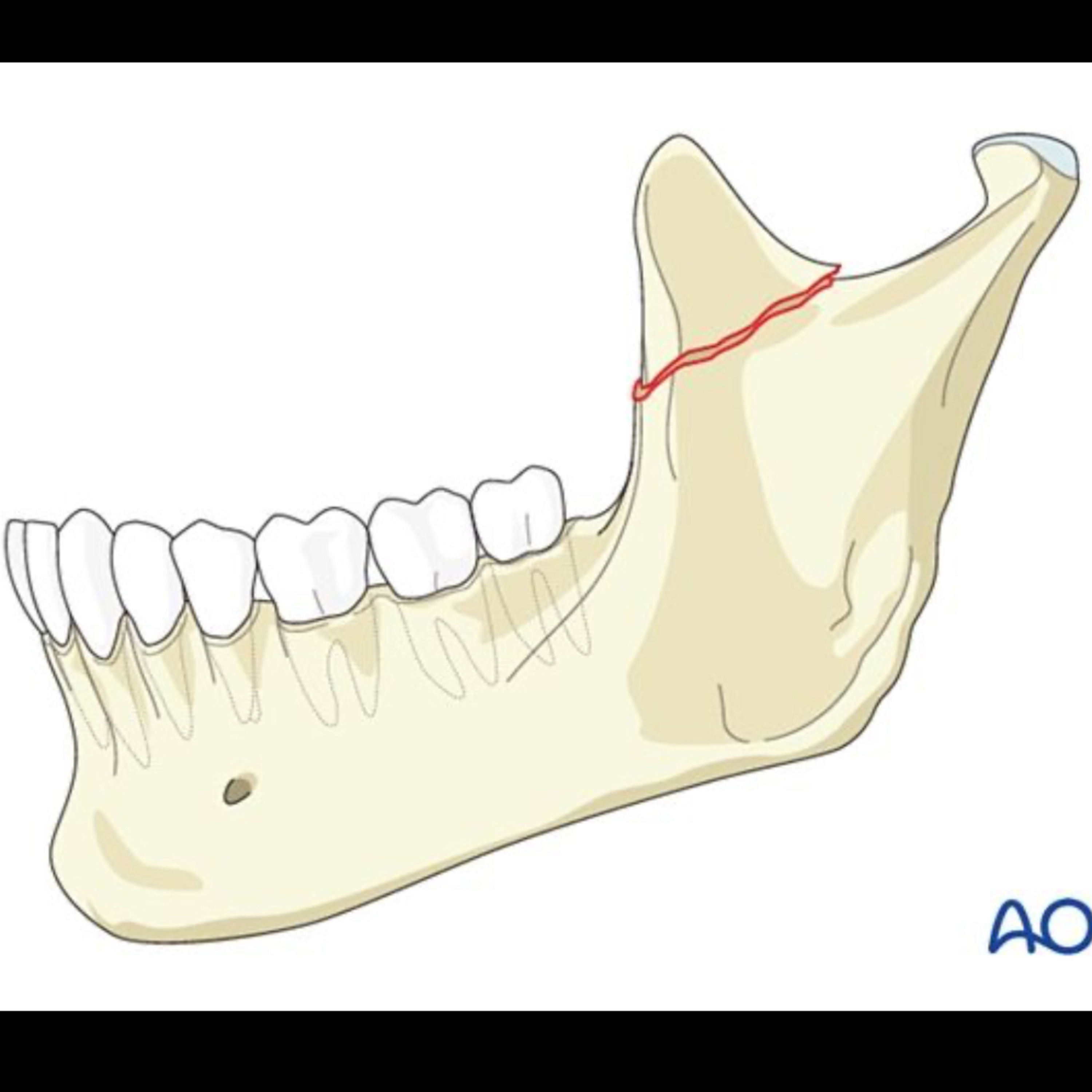 📝 “What is the Coronoidectomy via Intraoral Approach?”