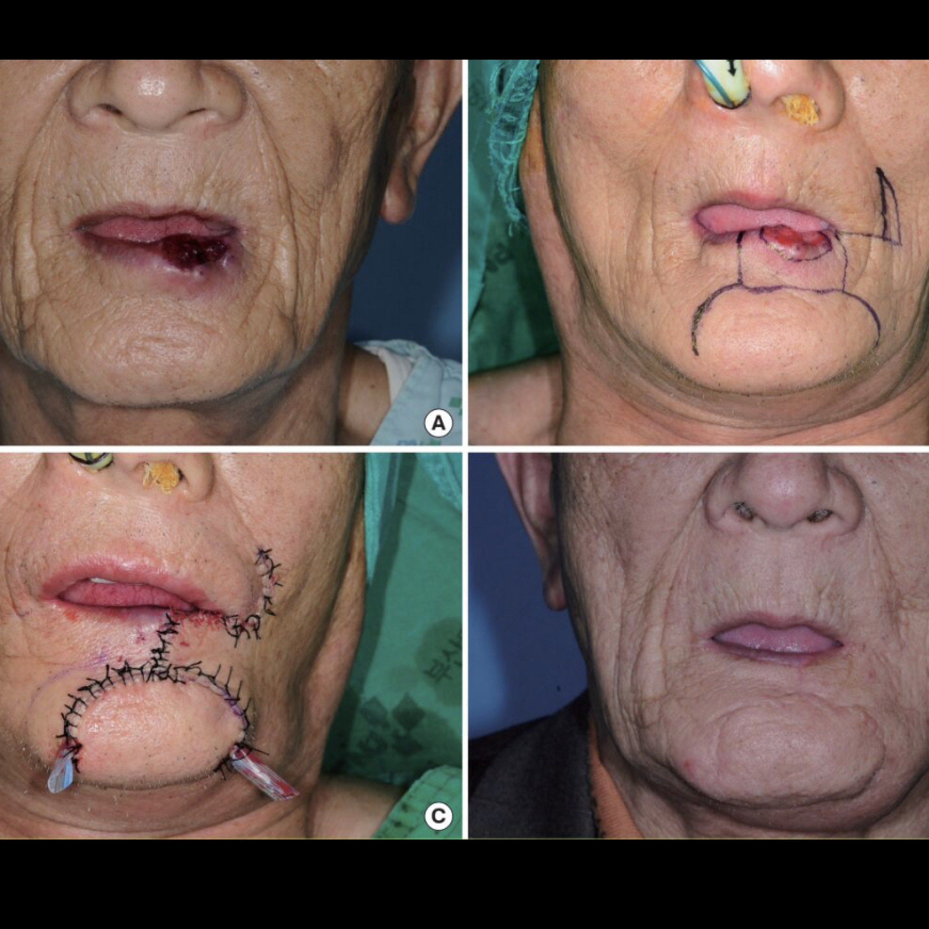 📝 "What is the Webster Operation?"