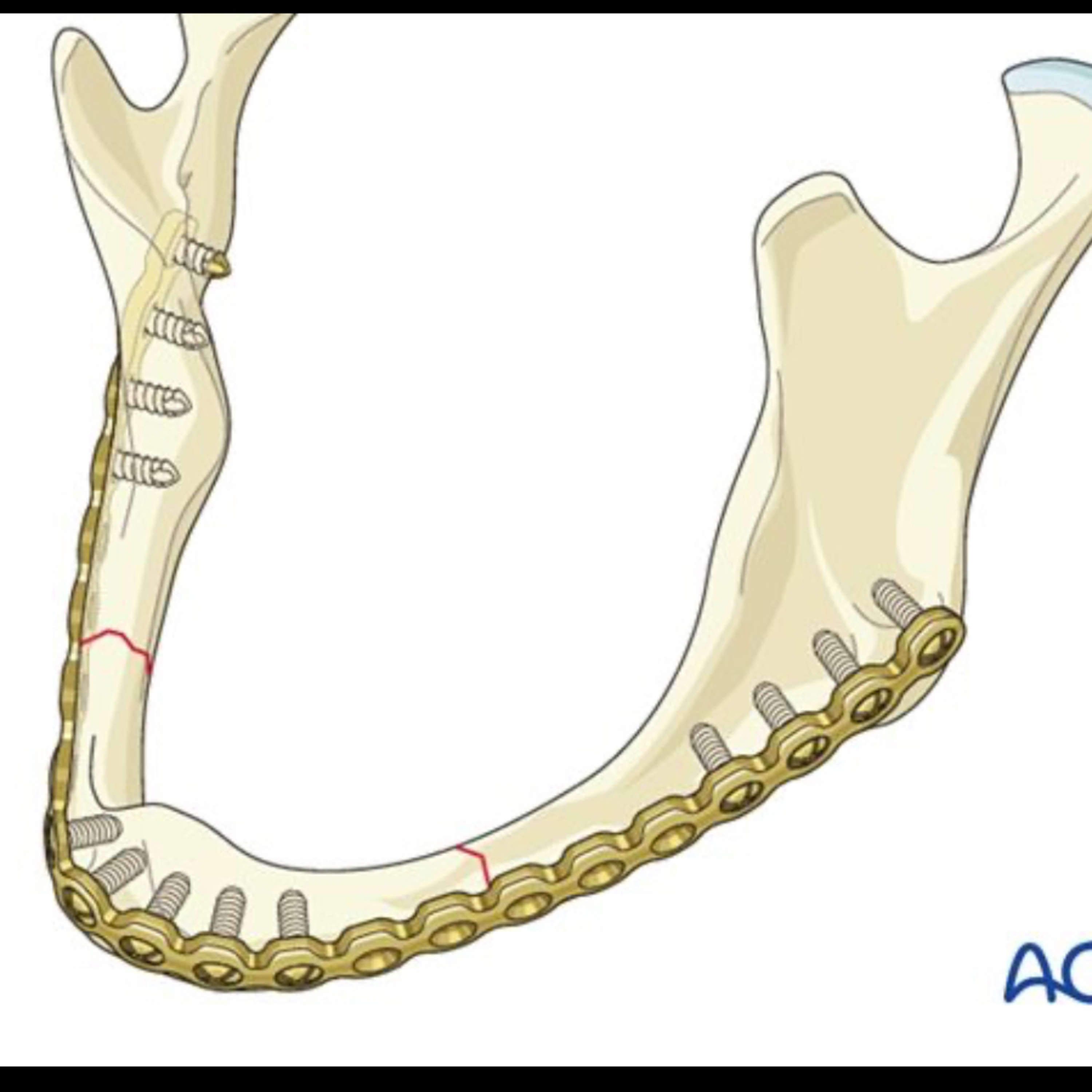 📝 “How Does The “Recon Plate” Differ From Other Fixation Options?”
