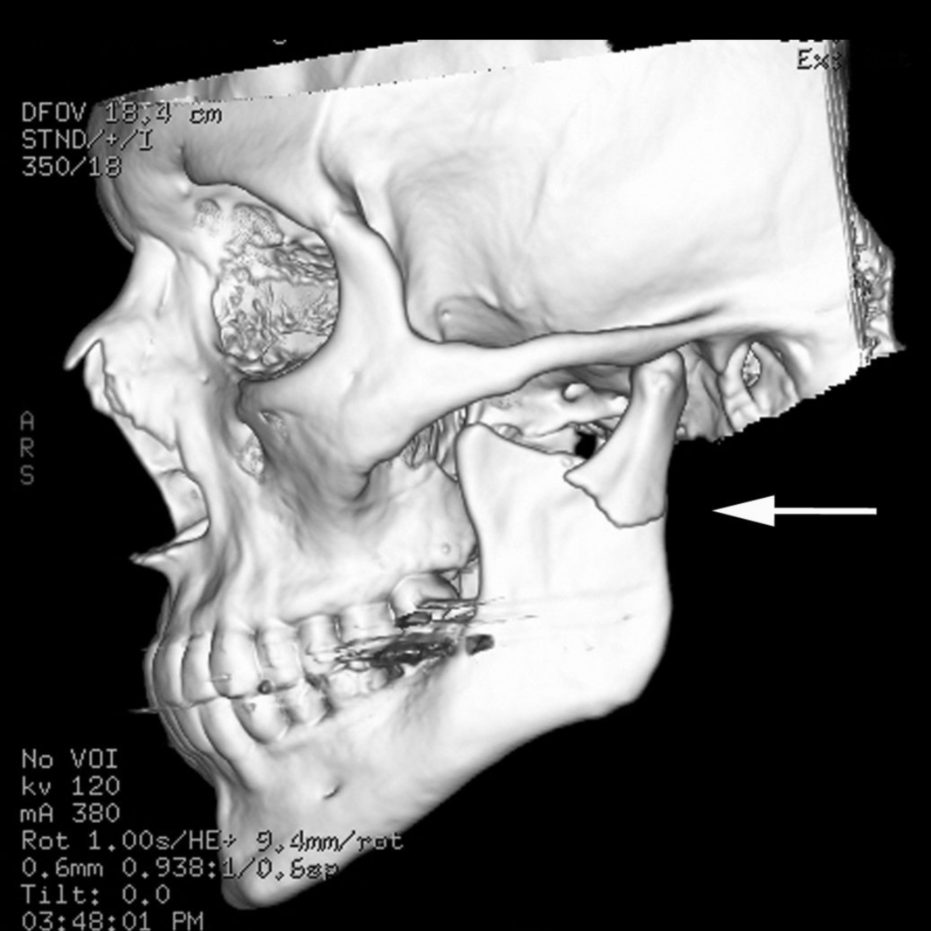 📝 “What Are Primary Surgical Options To Repair A Subcondylar Fracture?”