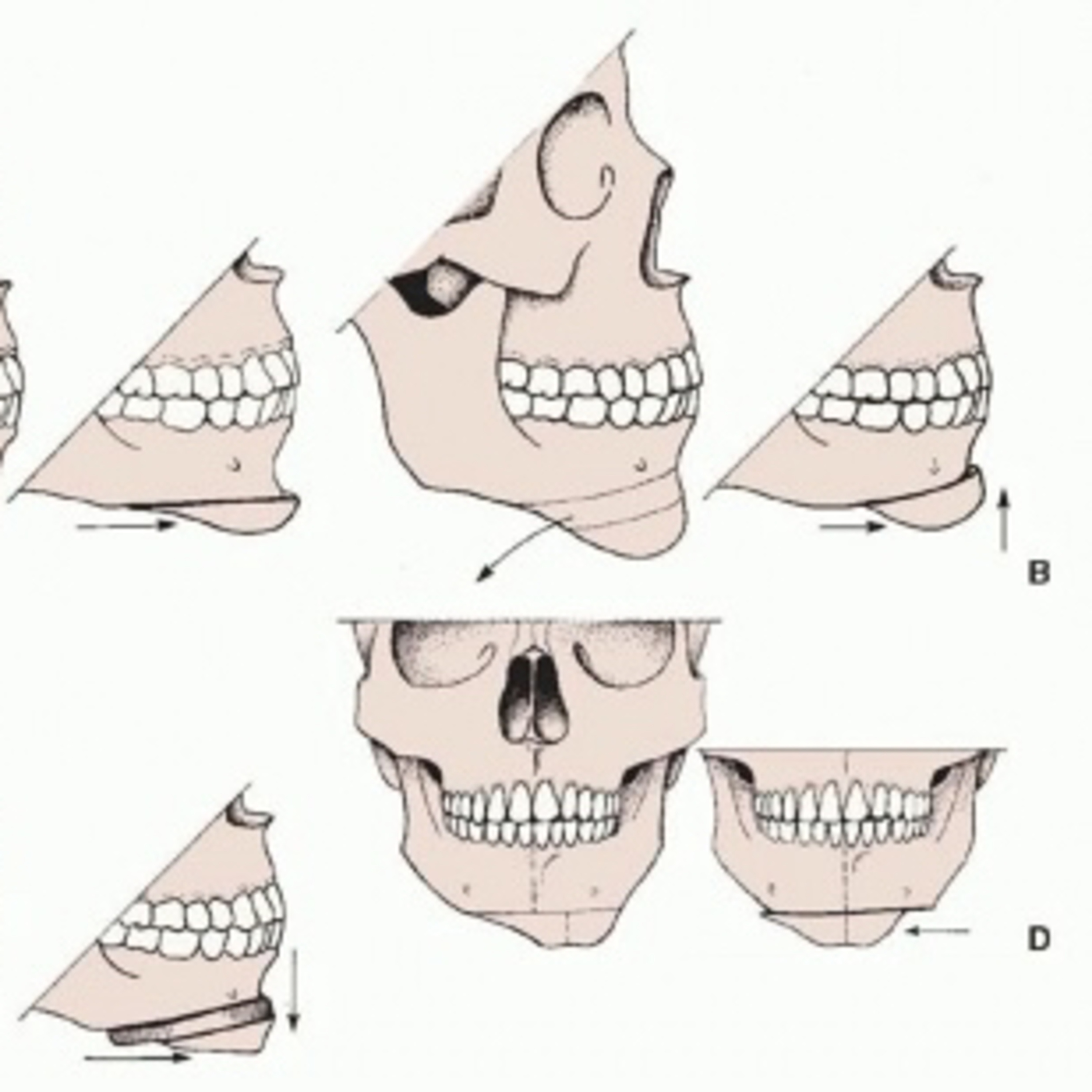 📝 “What is the Genioplasty Procedure?”