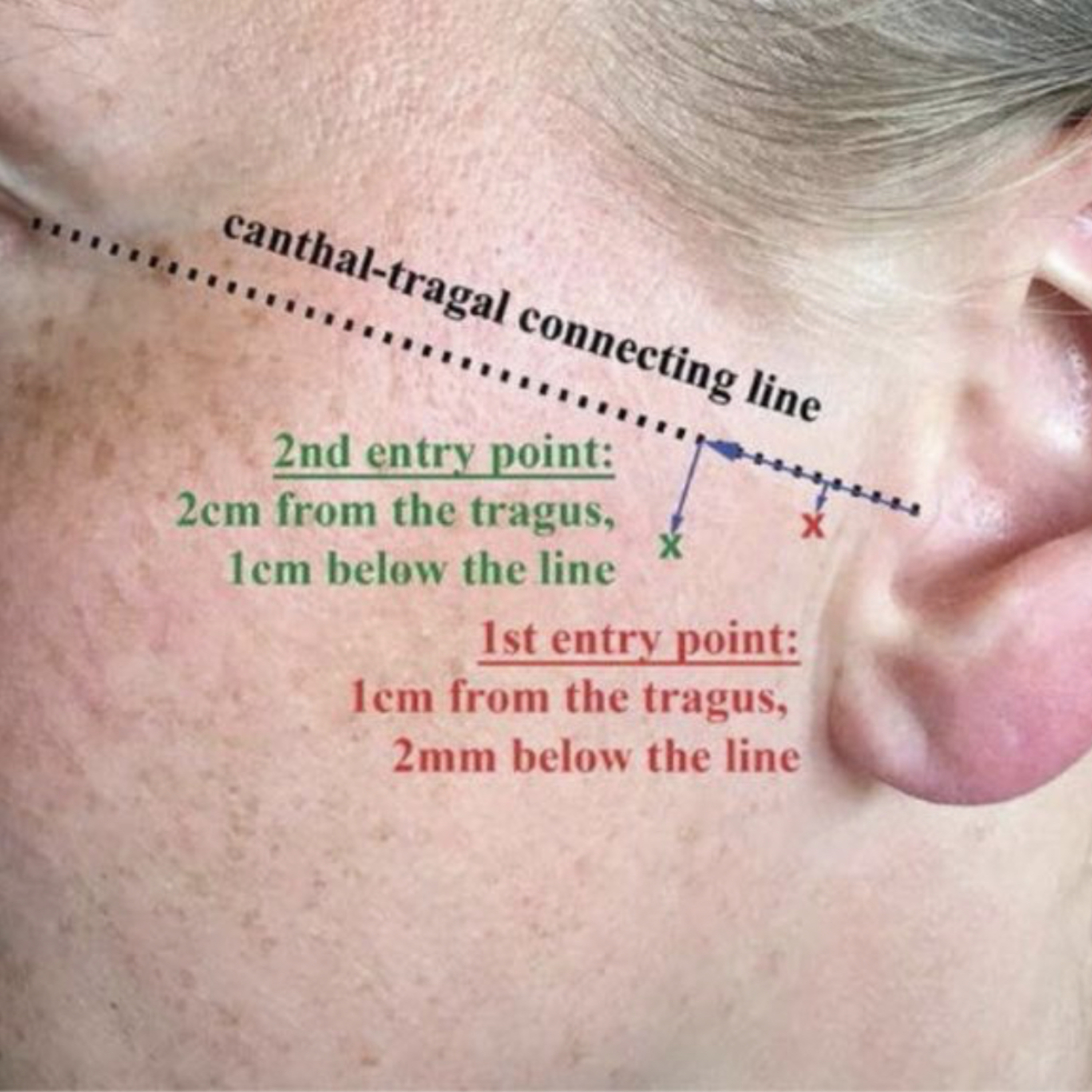 📝 “What is the Canthal-Tragal Line?”