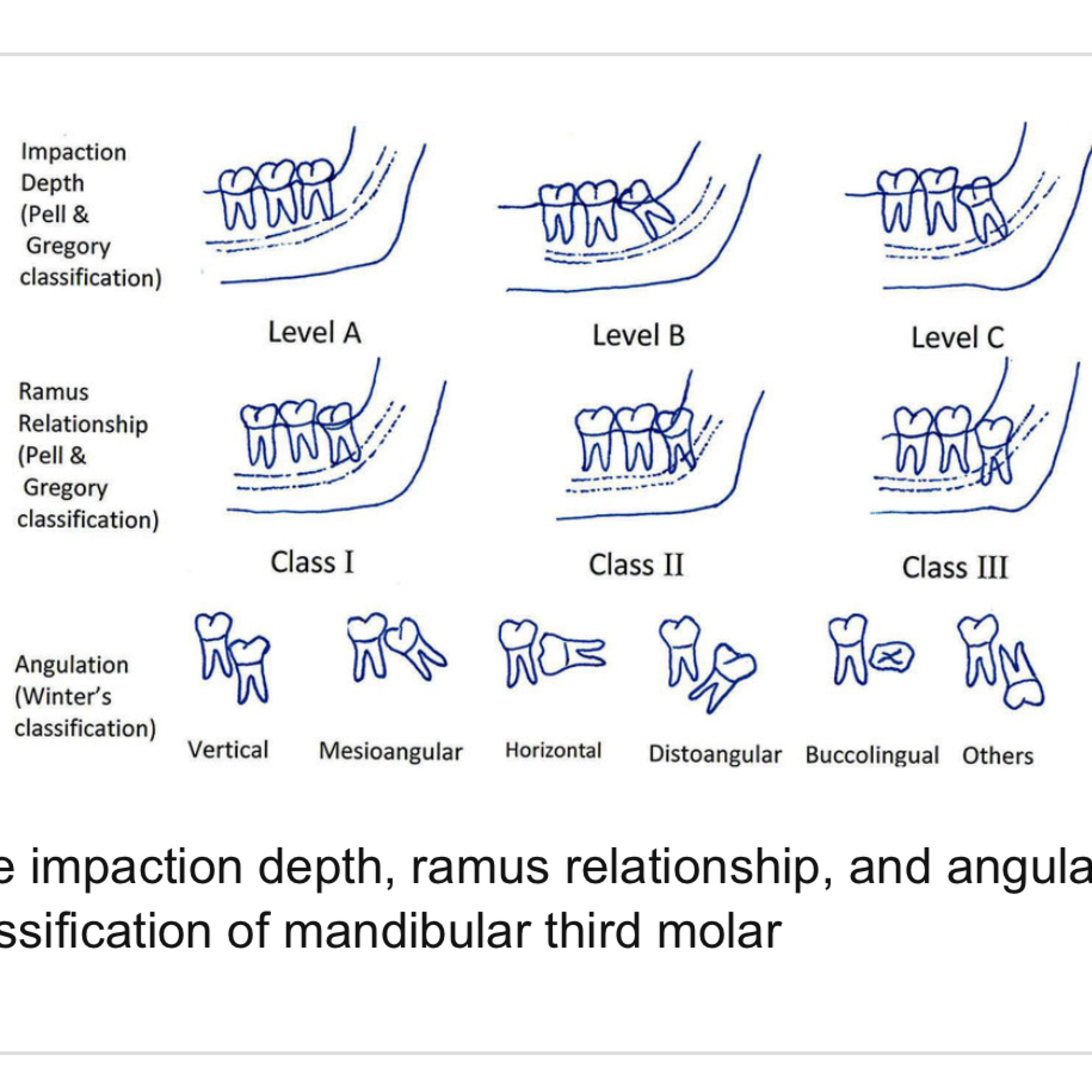 “What are the Classifications of Third Molars?”