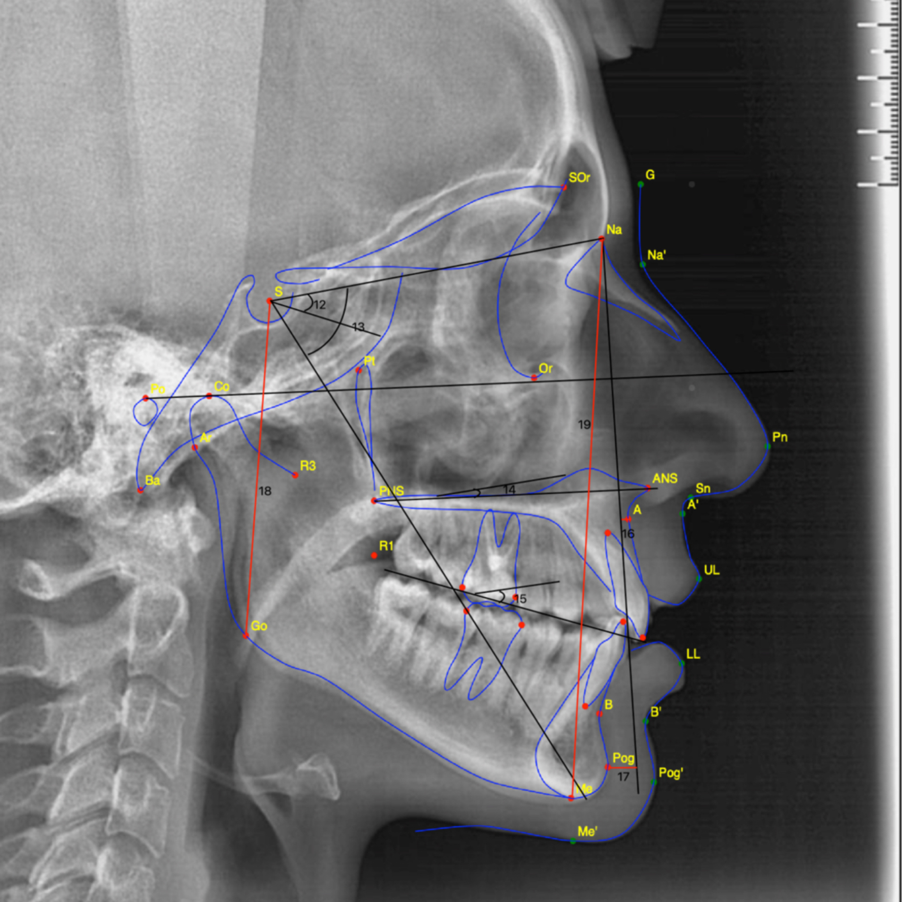 “What is a Key Cephalometric Metric for Vertical Maxillary Excess?”