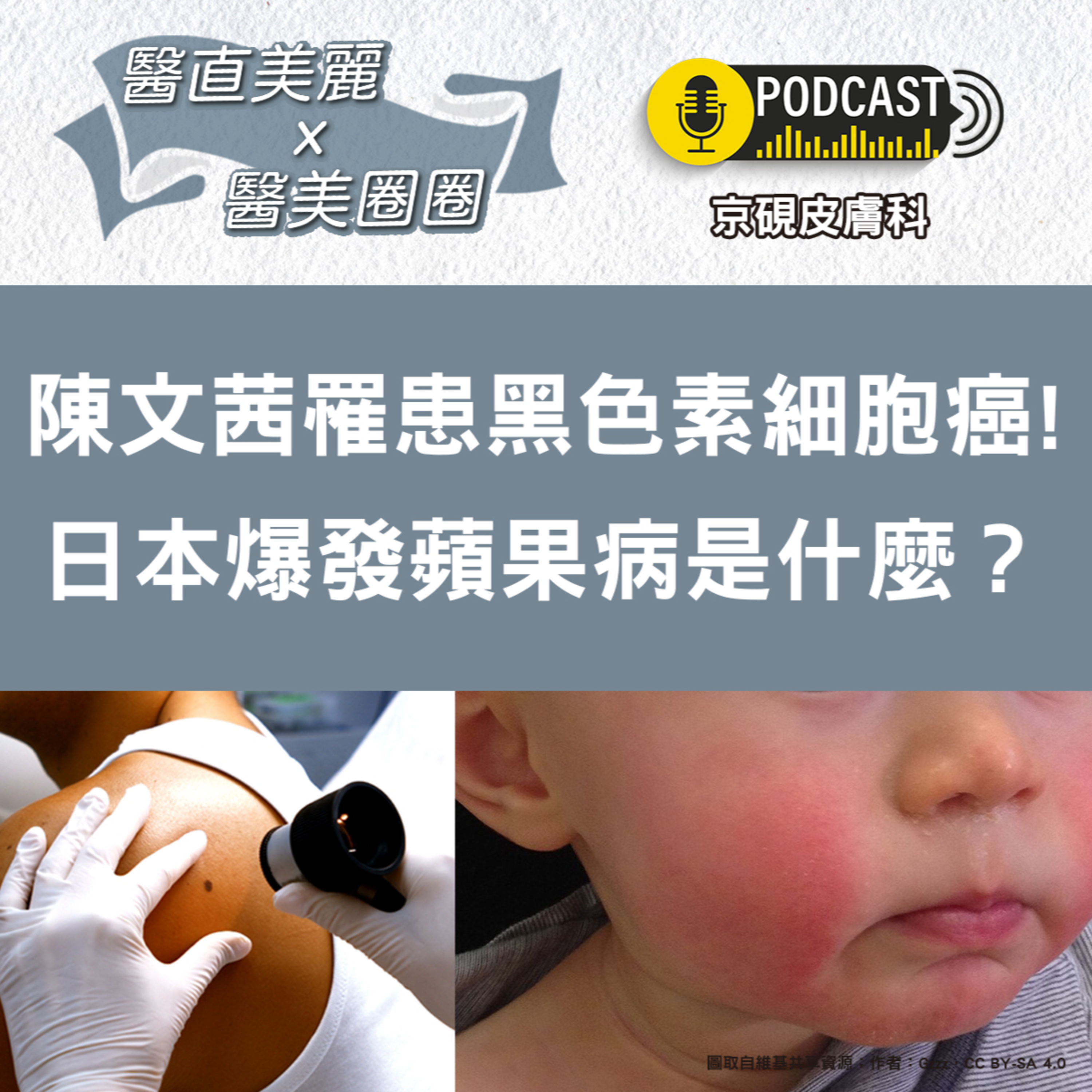 cover of episode 【S2 EP.041】陳文茜罹患黑色素細胞癌! 日本爆發蘋果病是什麼？