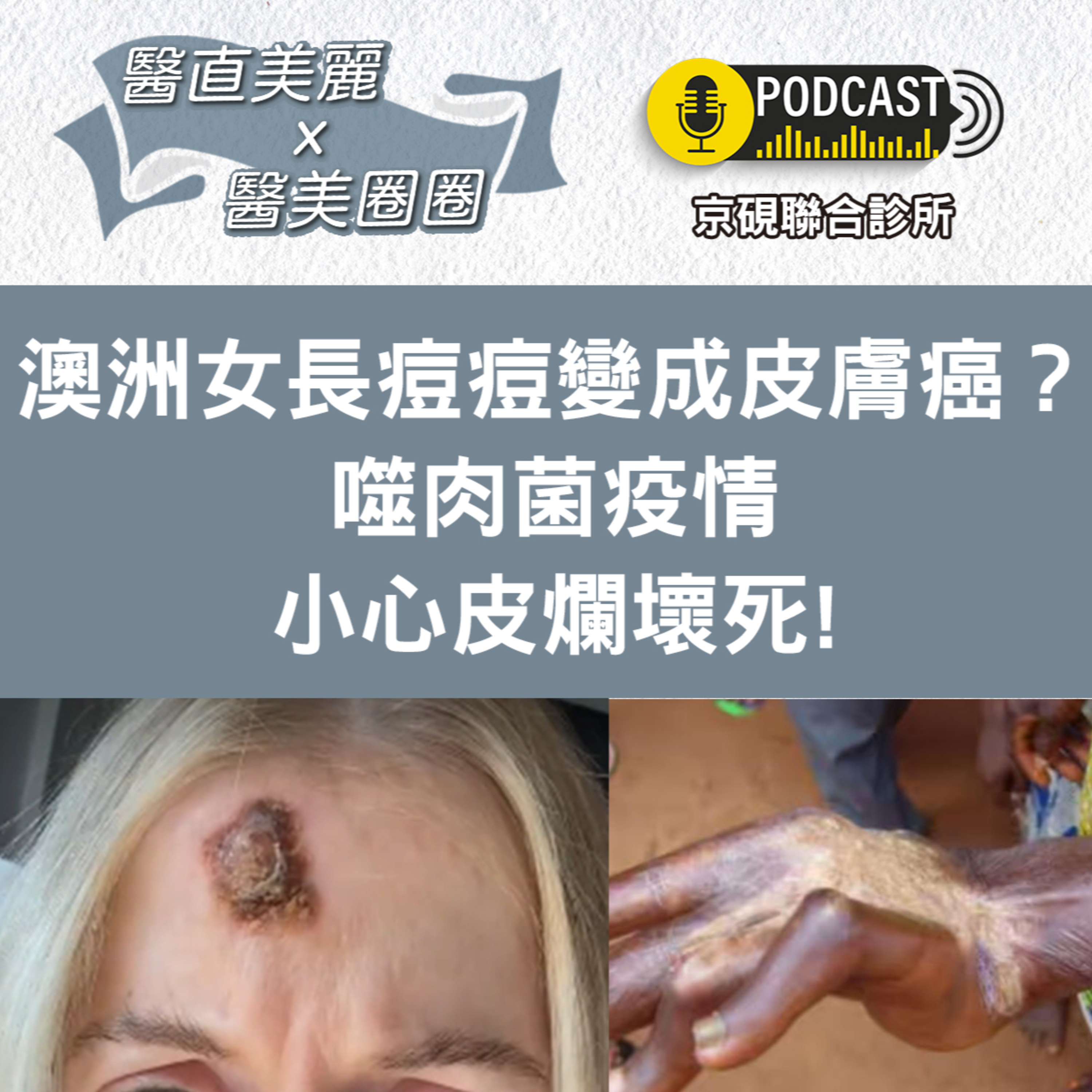 cover of episode 【S2 EP.046】澳洲女長痘痘怎麼變成皮膚癌？ 噬肉菌疫情小心皮爛壞死!