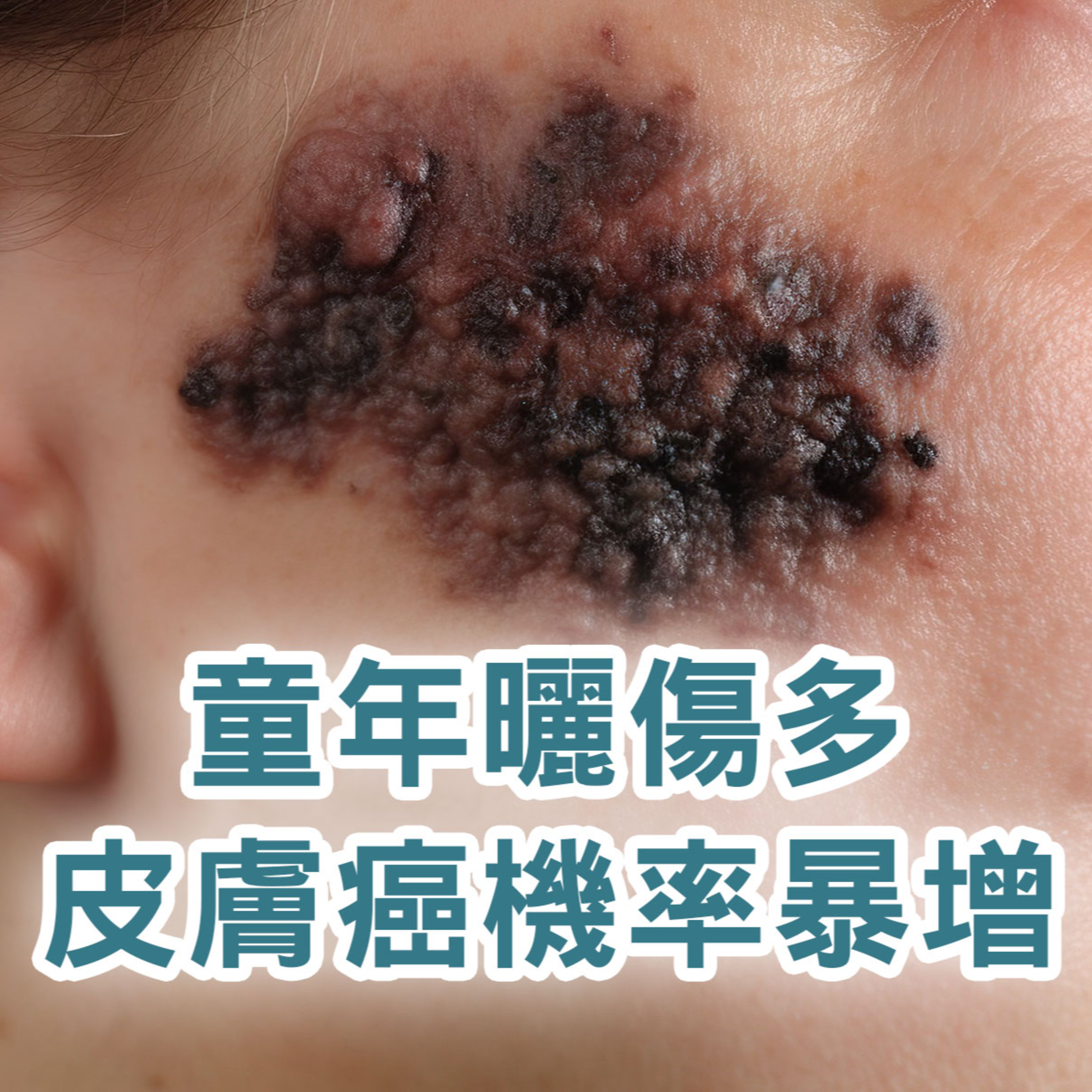 【S2 EP.102】童年多次曬傷，長大皮膚癌機率暴增！