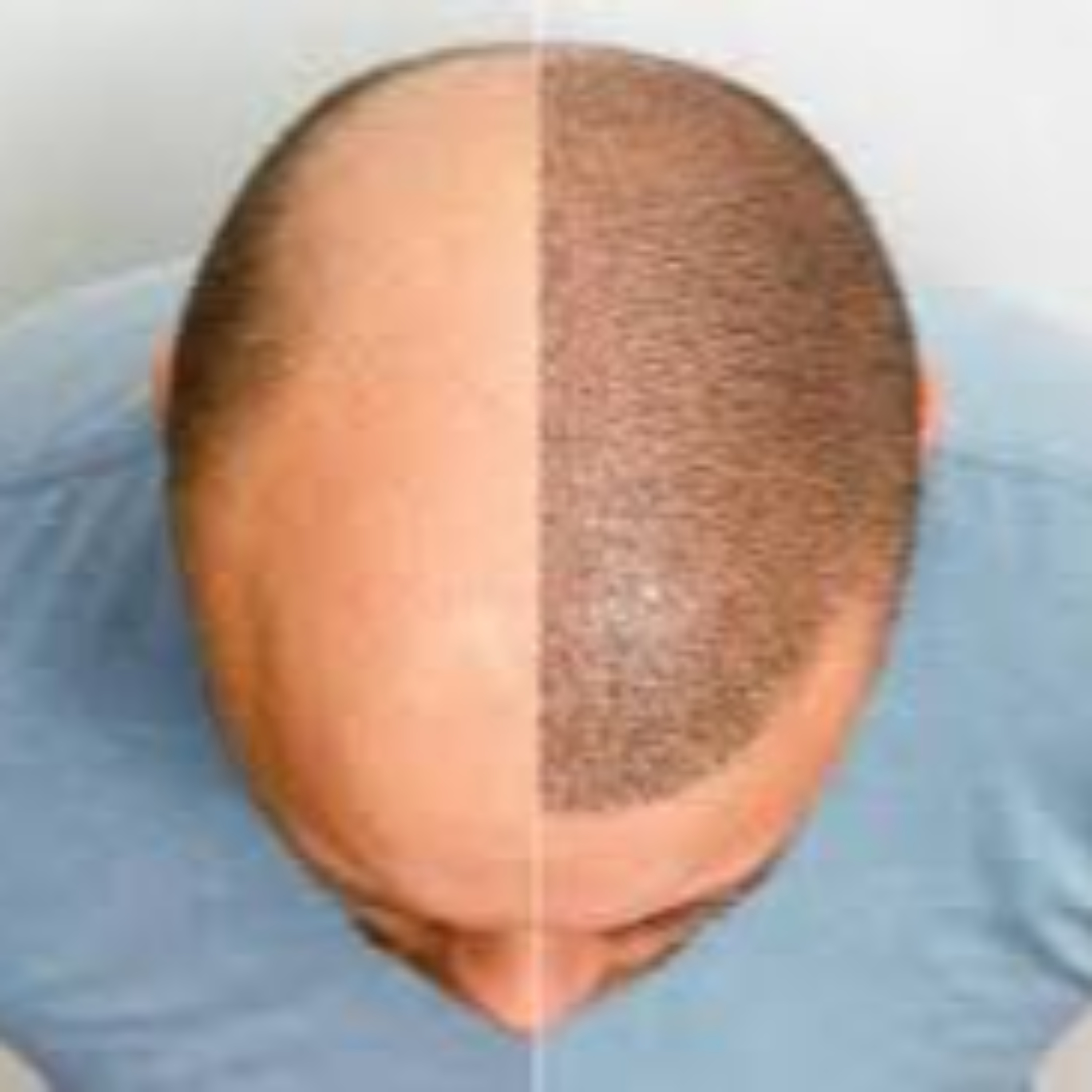 hair transplant guide podcast artwork