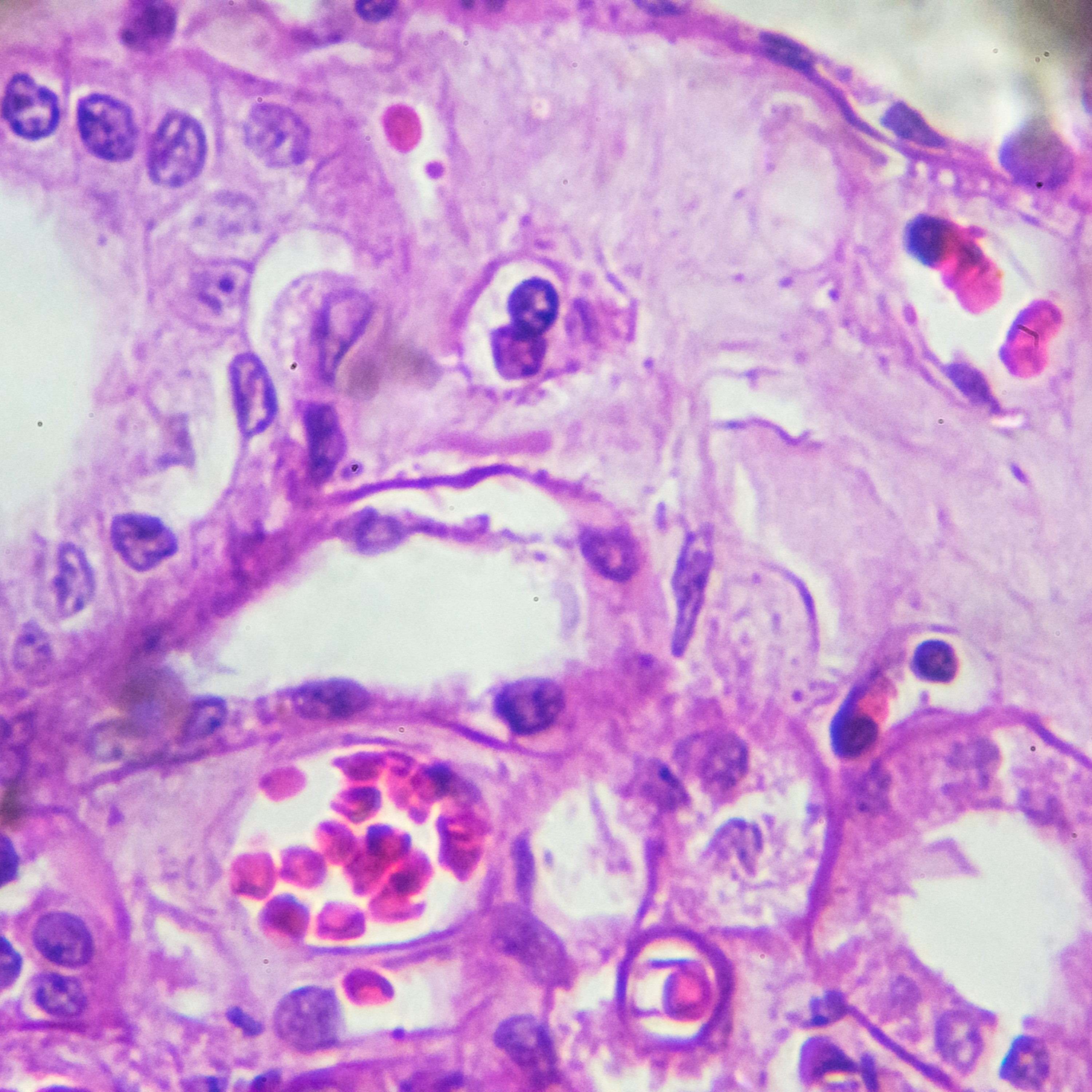 C3 Glomerulopathy: From Early Recognition to Individualized Targeted Therapy